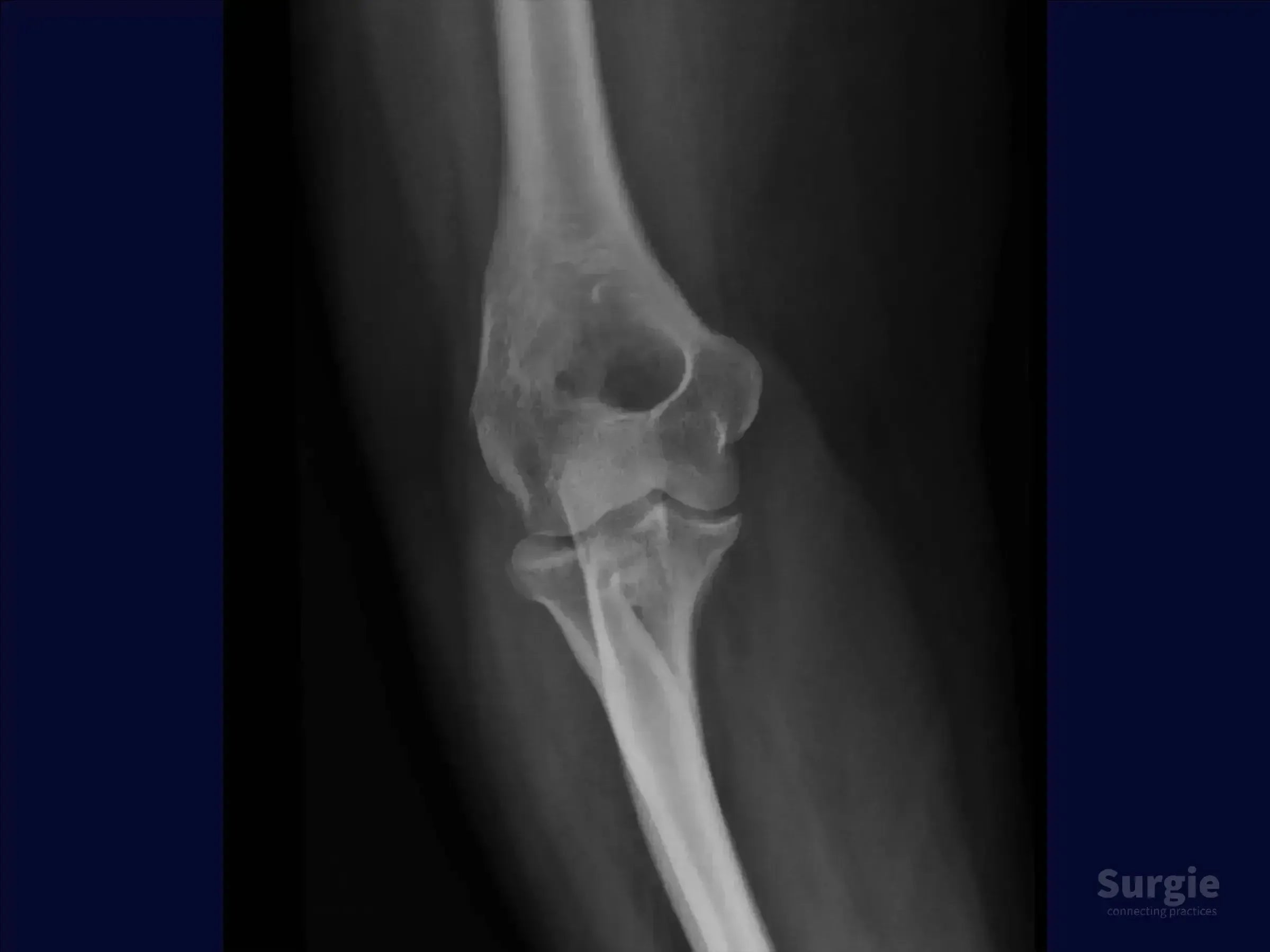 X-ray showing a complex Mason 3 multifragmentary radial head fracture with elbow joint instability.