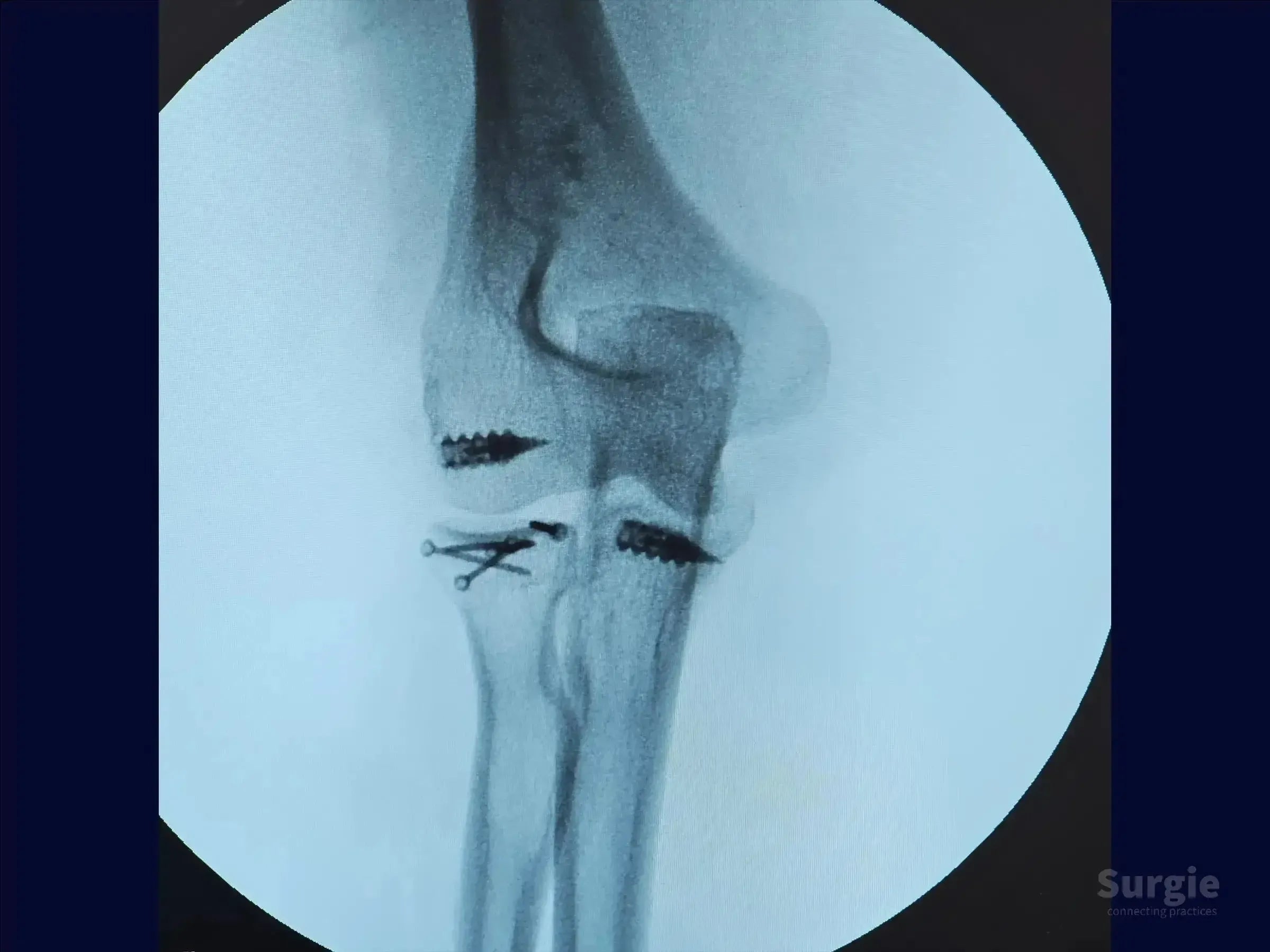 X-ray of a Mason 3 radial head fracture stabilized with metallic screws and pins in the elbow joint.