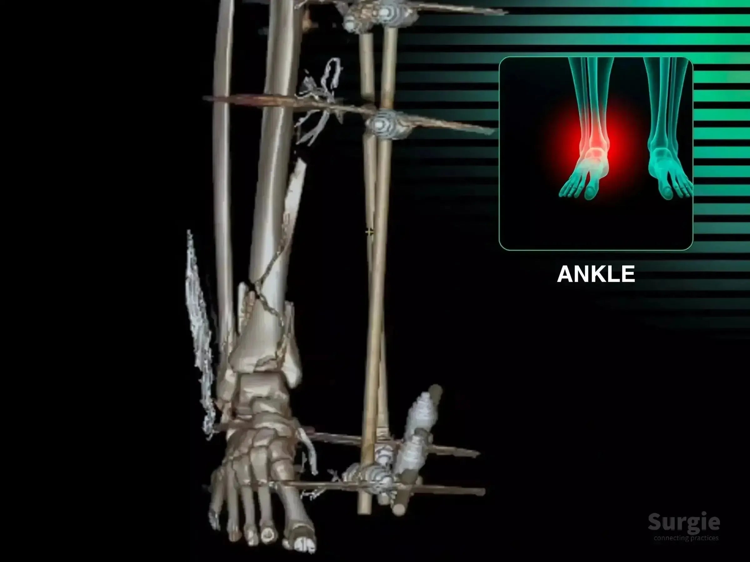 3D CT scan of a multi-fragmentary tibial pilon fracture with external fixation and an ankle pain highlight.