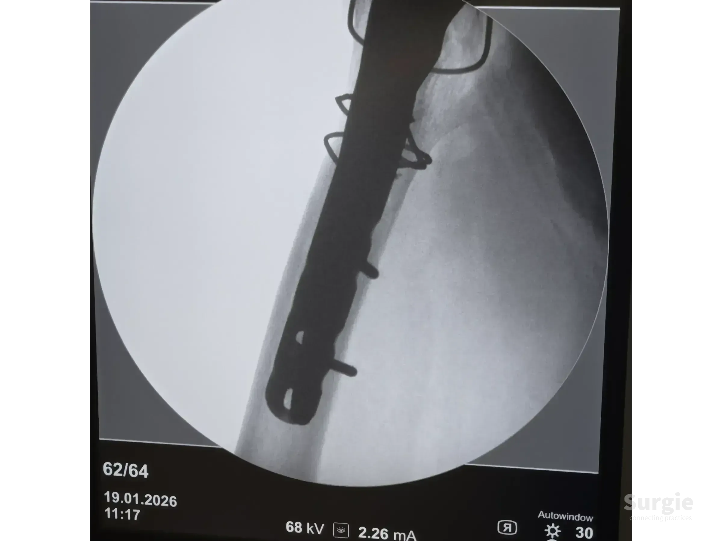 X-ray showing a metal trochanteric plate and cerclage cables securing a periprosthetic hip fracture on a femur.