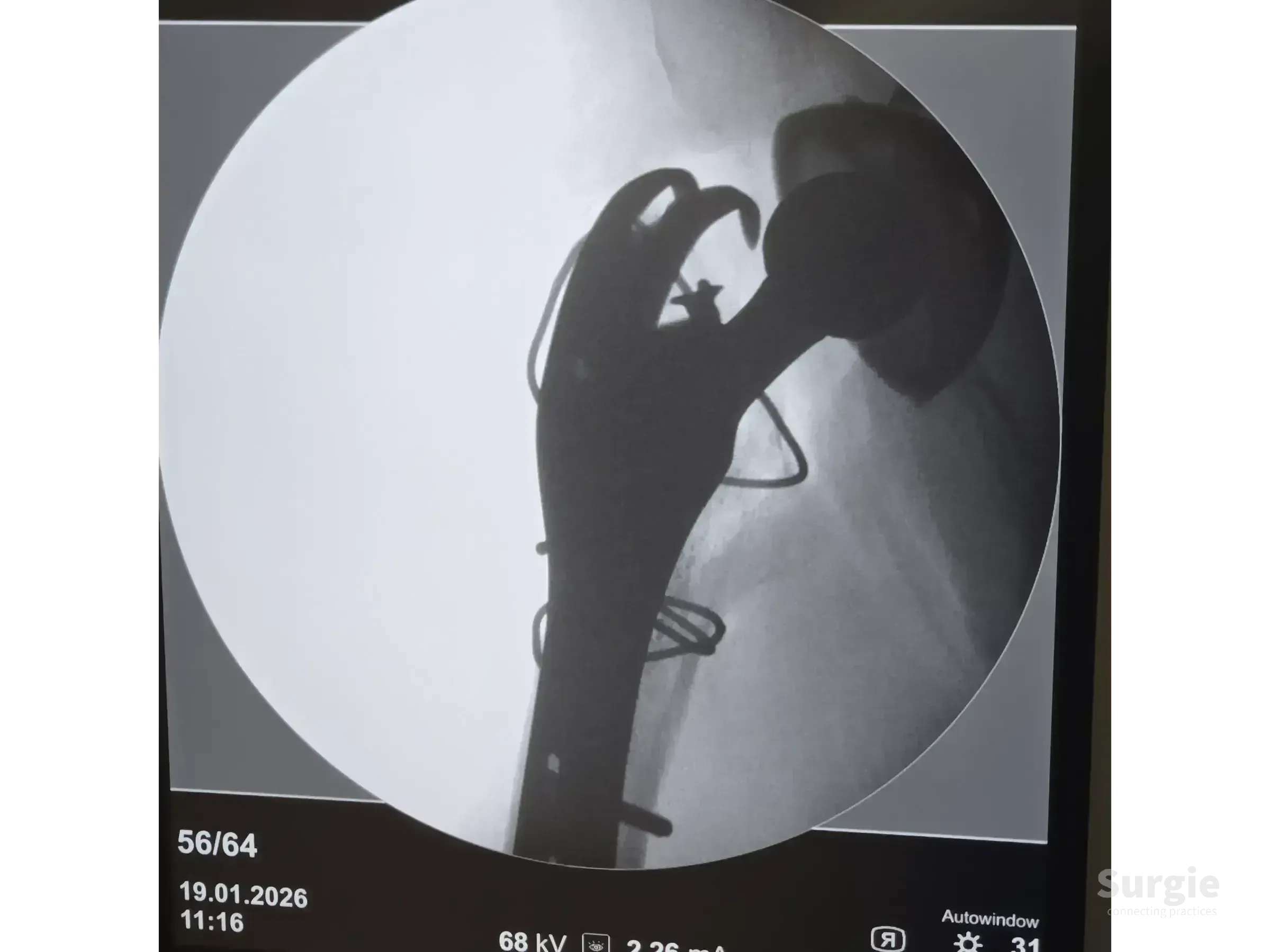 X-ray showing a periprosthetic hip fracture treated with a metallic trochanteric plate and cerclage cables.