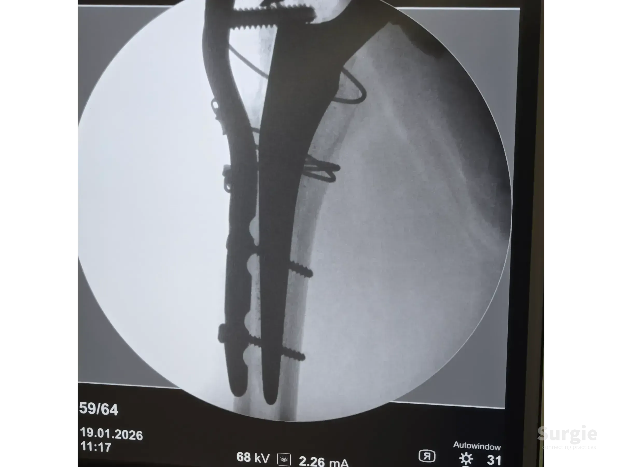 X-ray showing a metal trochanteric plate and cerclage cables securing a periprosthetic hip fracture on a femoral implant.