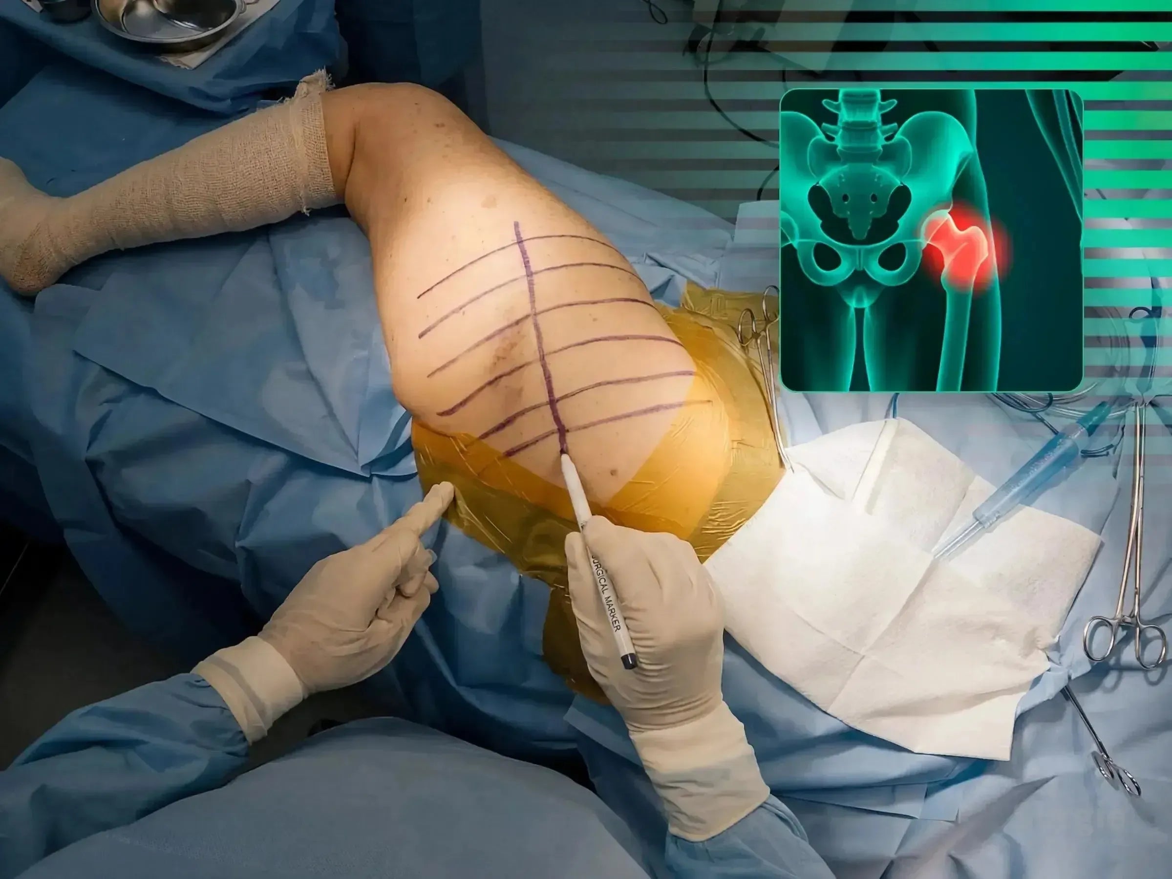 Surgeon marking a patient's hip for posterolateral surgery with a digital overlay of a periprosthetic hip fracture.