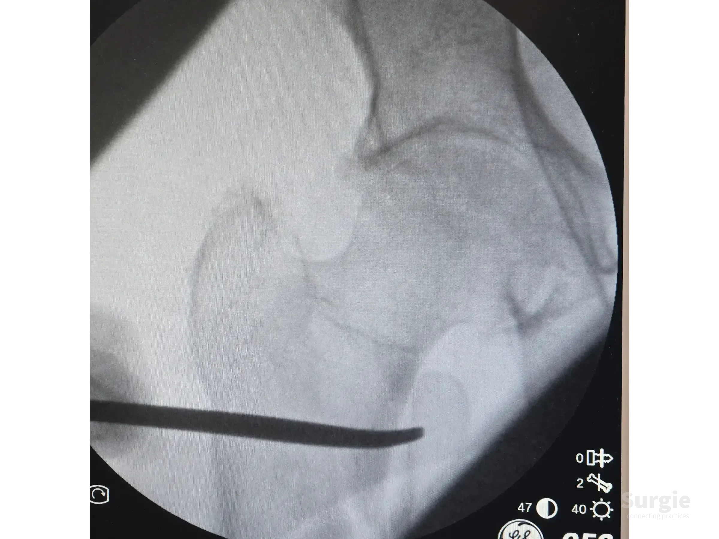 Fluoroscopic view of a proximal femur fracture reduction using a surgical instrument for the double see-saw technique.