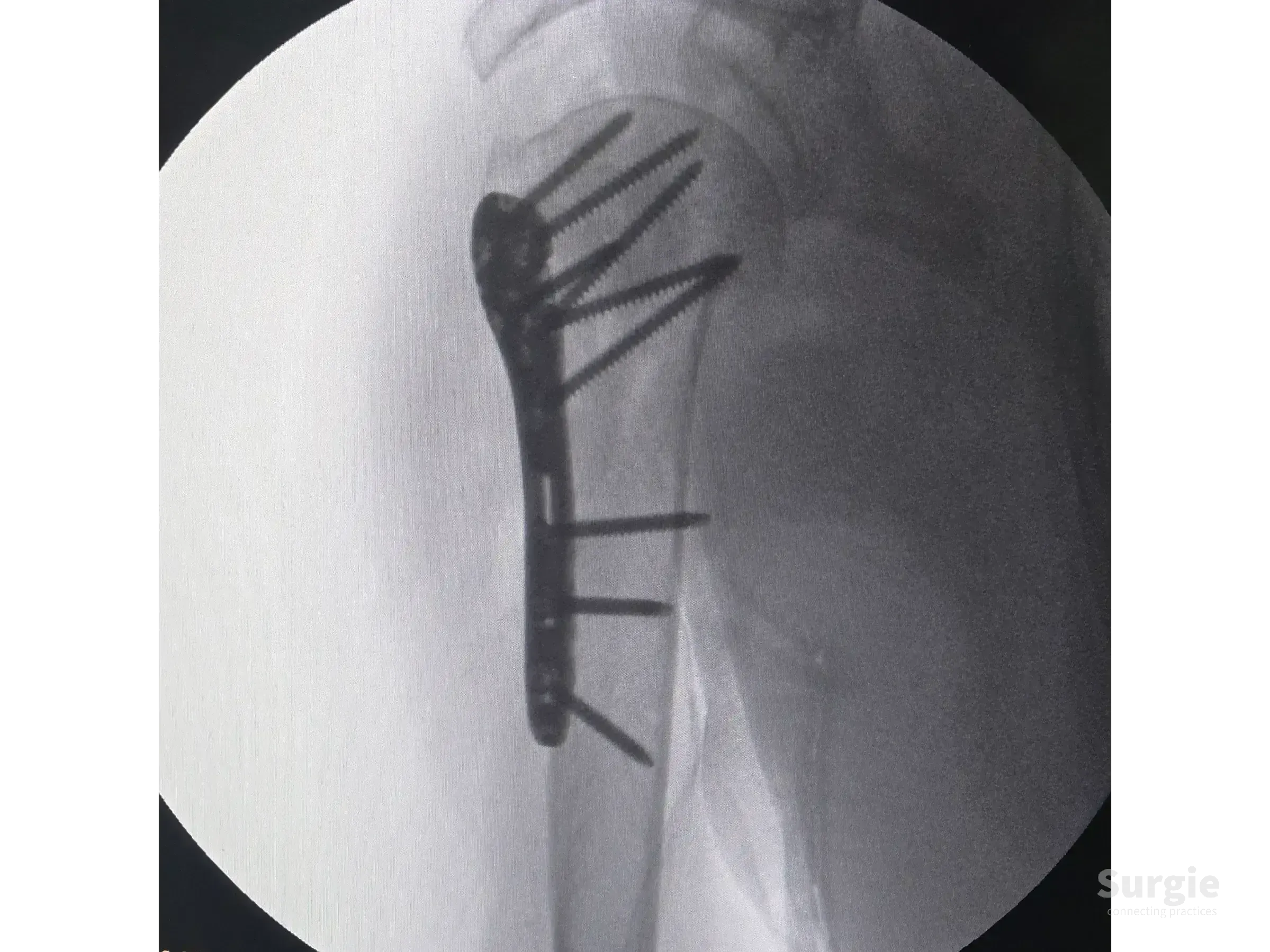 X-ray of a proximal humerus fracture fixed with a metallic locking plate and multiple screws for anatomical stability.