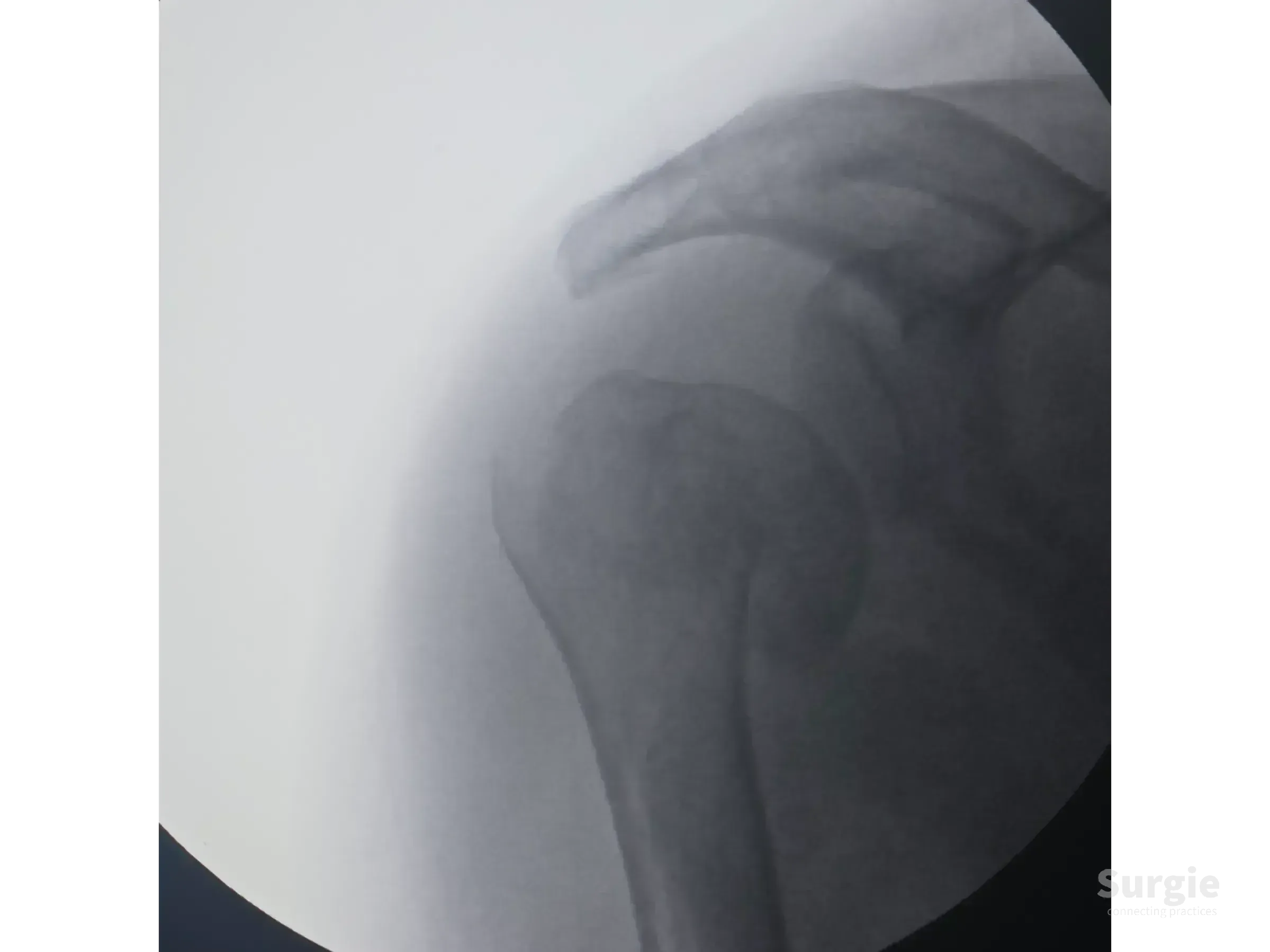 X-ray showing a two-part proximal humerus fracture with impacted varus displacement of the humeral head.