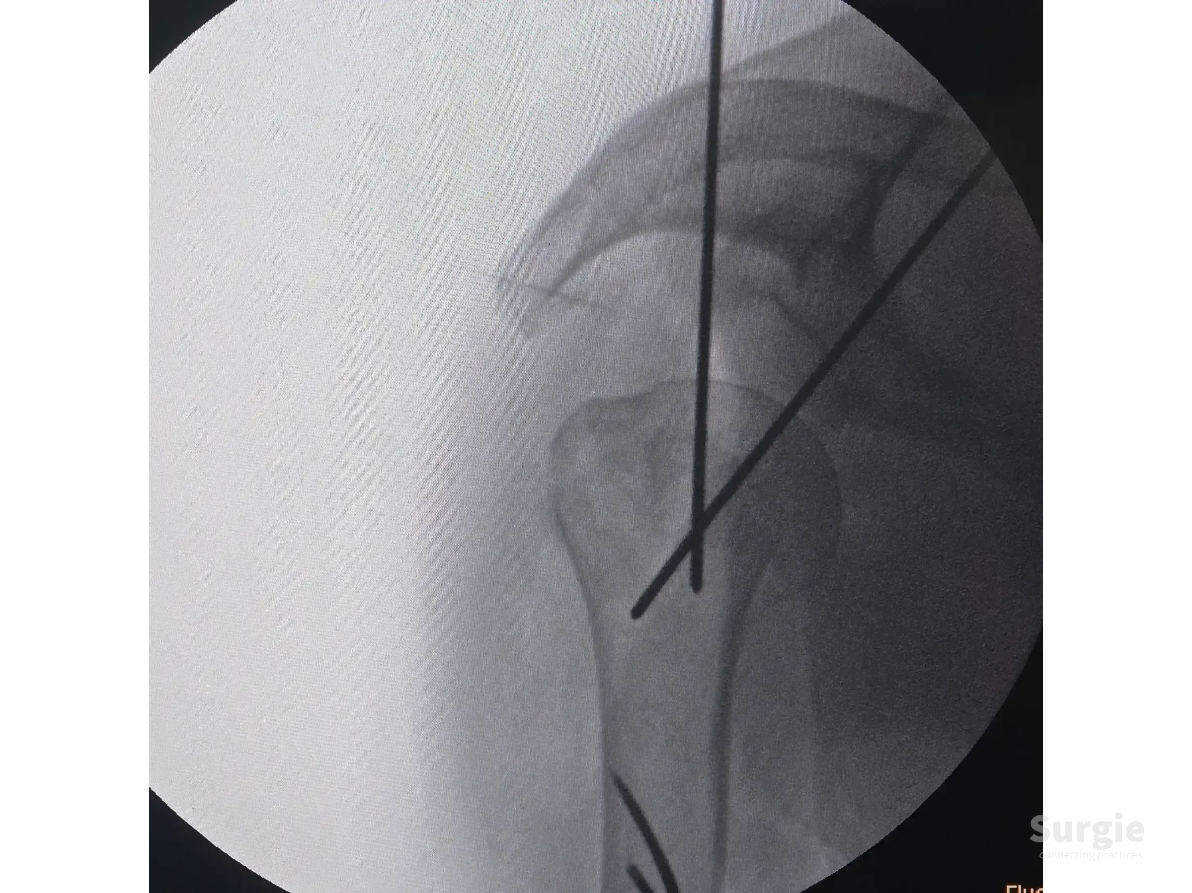 Fluoroscopic view of a proximal humerus fracture with Kirschner wires used for reduction and stabilization.