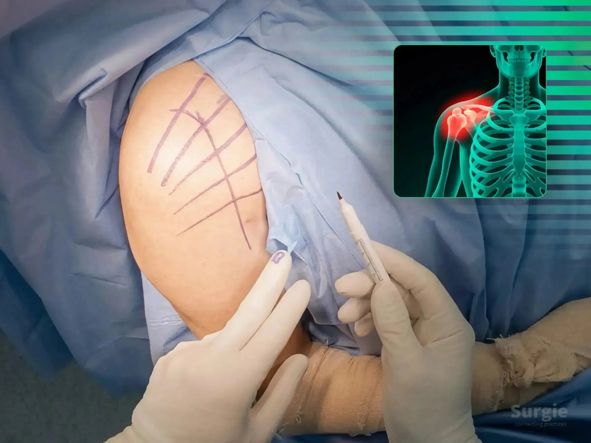 Surgical marking on a patient's shoulder for proximal humerus fracture repair with a digital anatomical overlay.