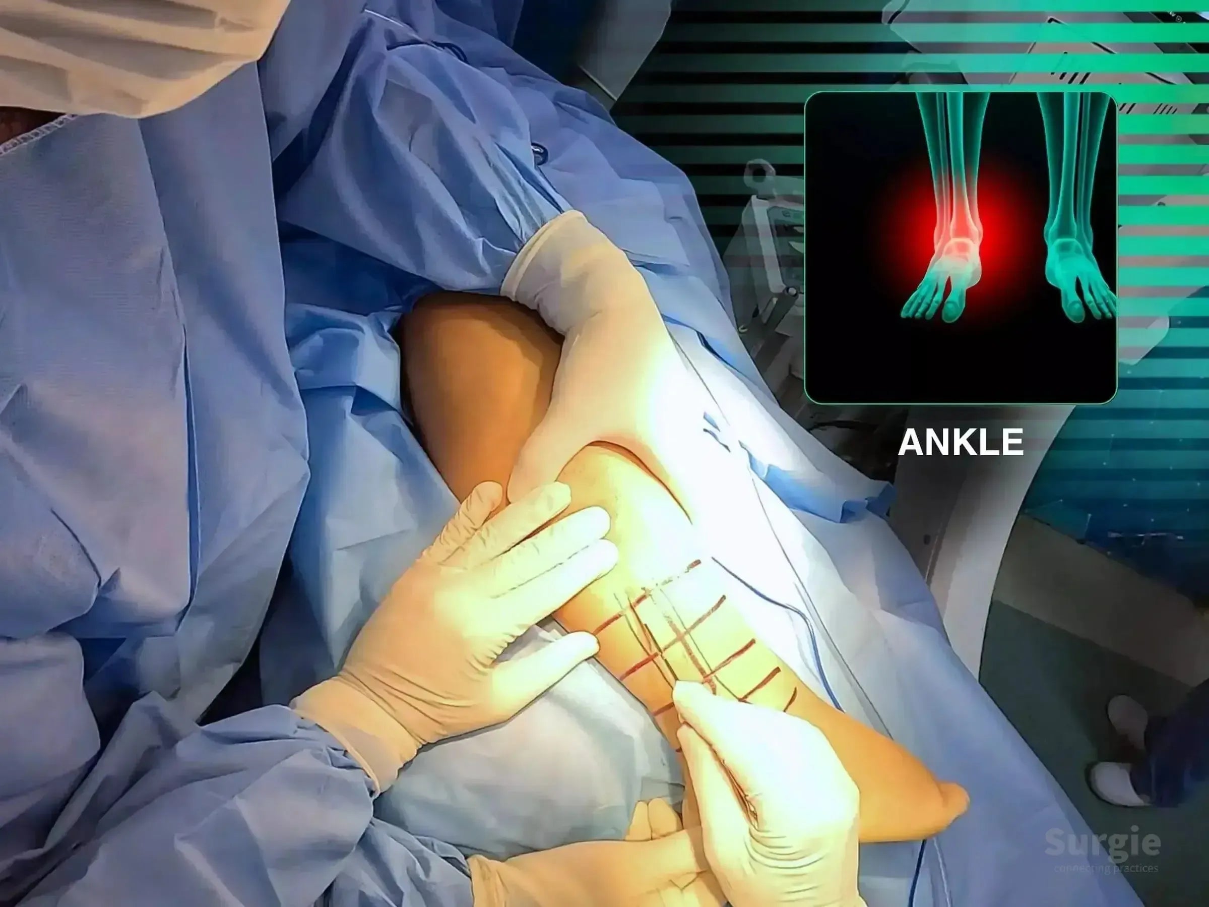 Surgeon marking a patient's ankle for a posterolateral approach with an anatomical X-ray overlay of the fracture site.