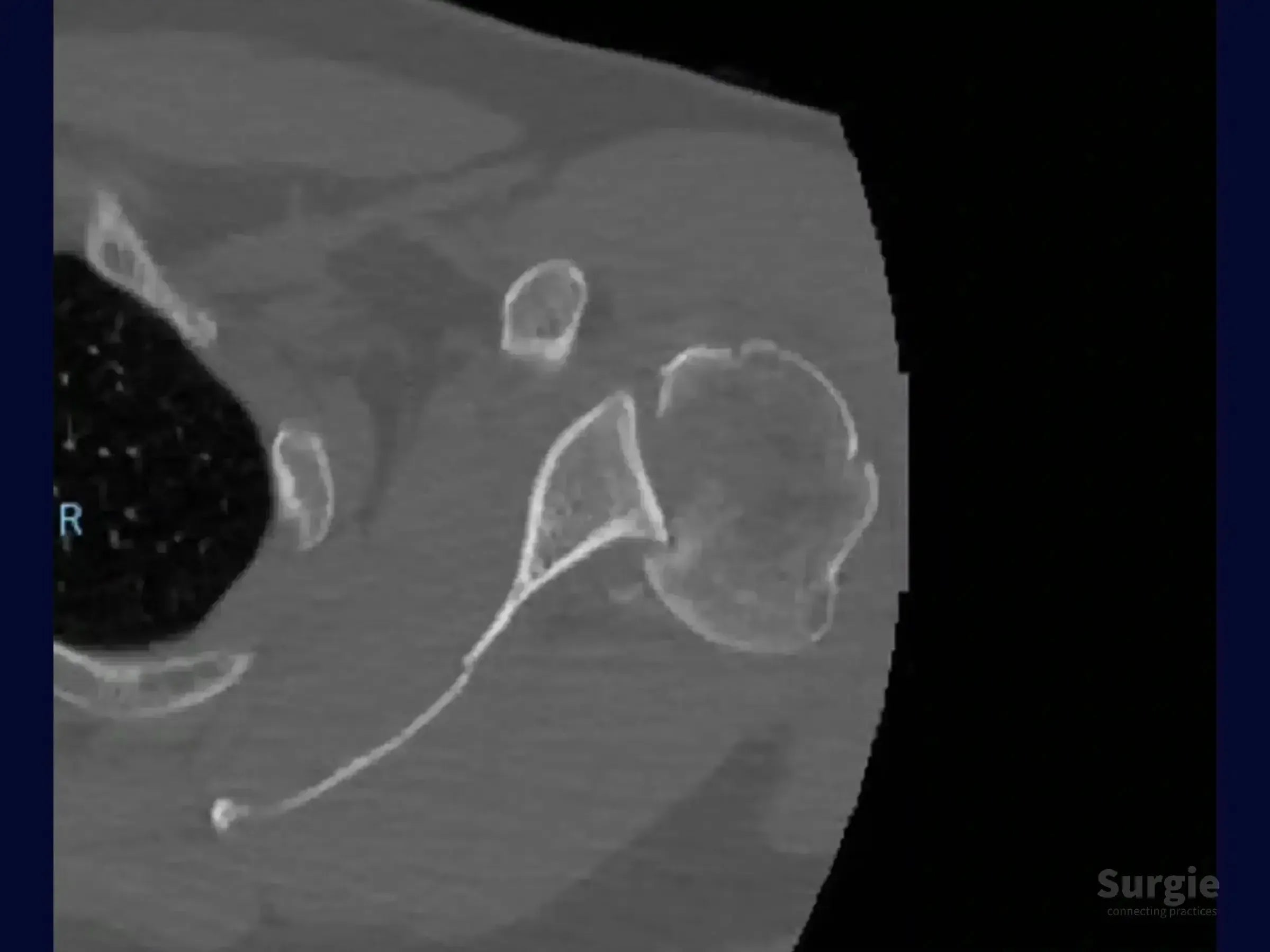 Axial CT scan showing a posterior shoulder dislocation with a humeral head impaction fracture.