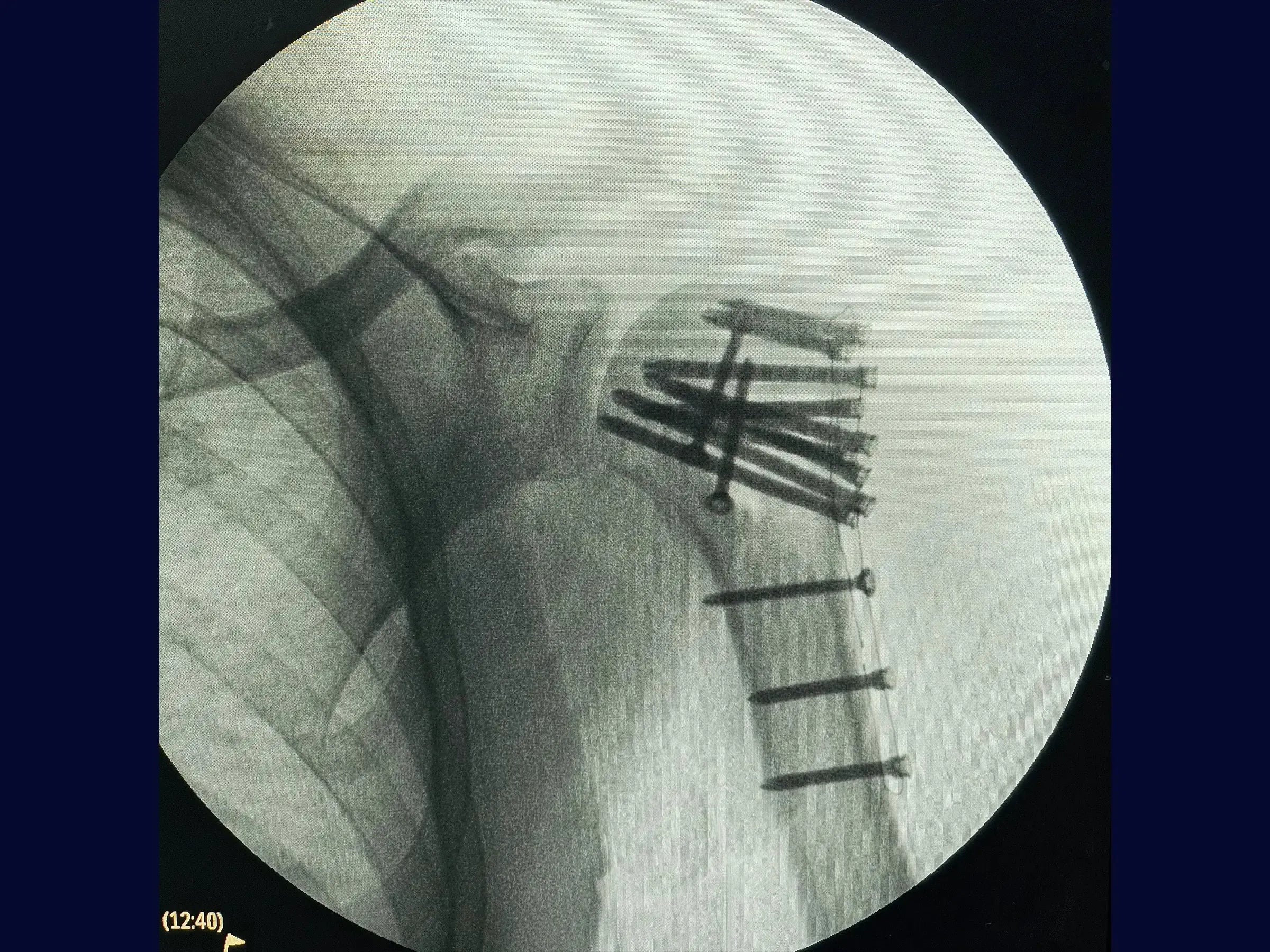 Posteriore Schulterluxation mit Humeruskopfanprall