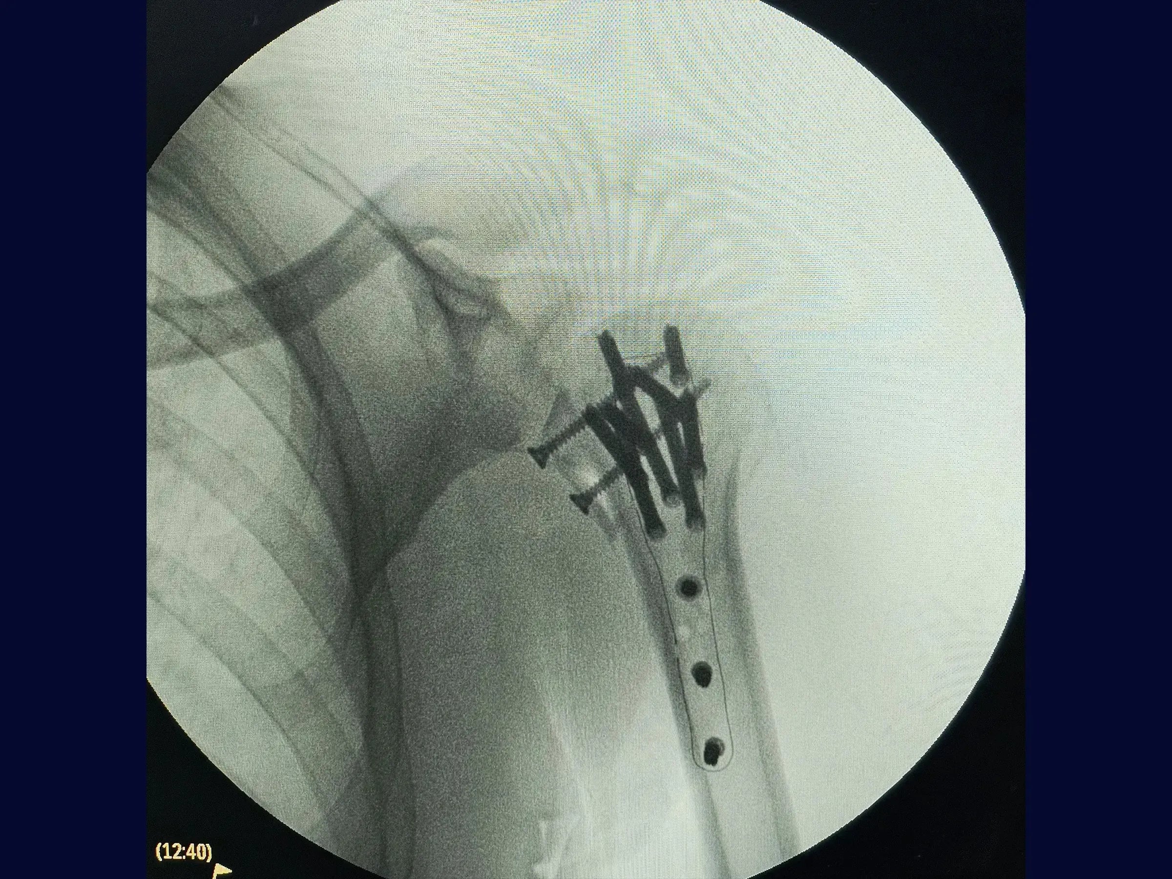 Posteriore Schulterluxation mit Humeruskopfanprall