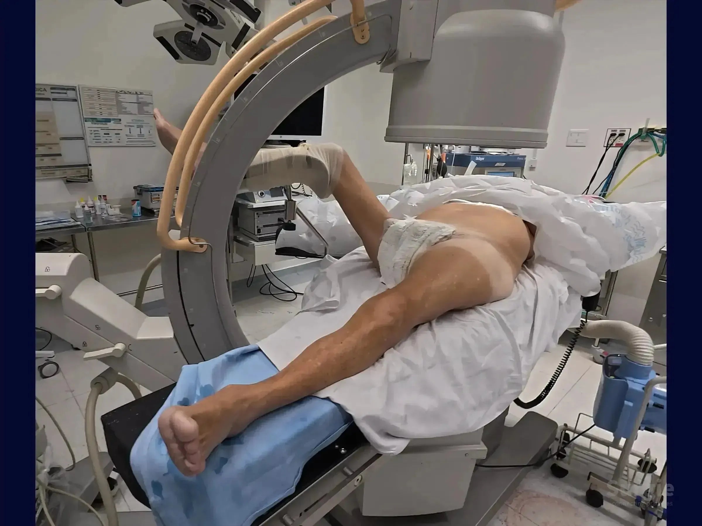 Patient positioned on a conventional surgical table with a C-arm for proximal femur fracture surgery.