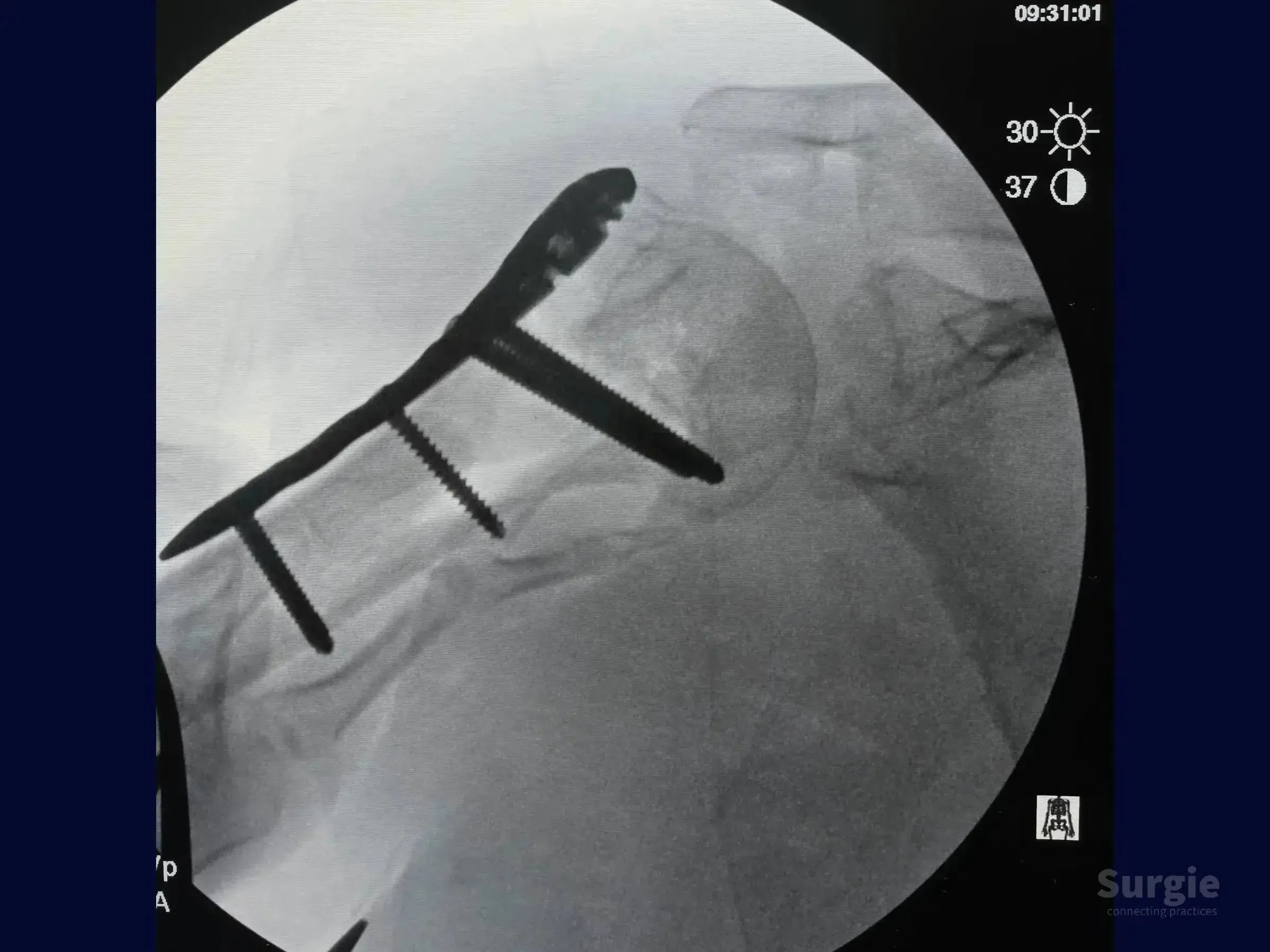 Fluoroscopic view of a proximal humerus fracture fixed with a metallic locking plate and screws for anatomical reduction.