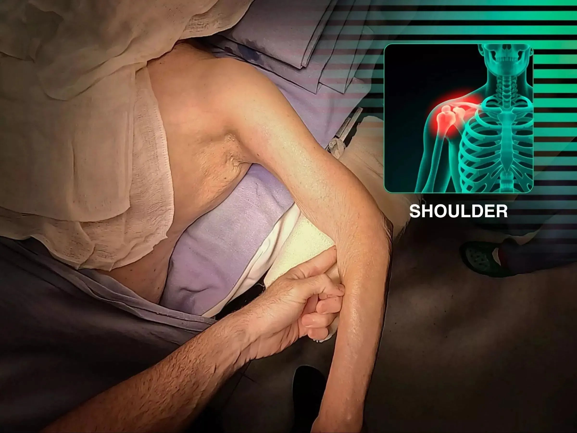 Proximal Humerus Fracture with Plate (Deltopectoral Approach)