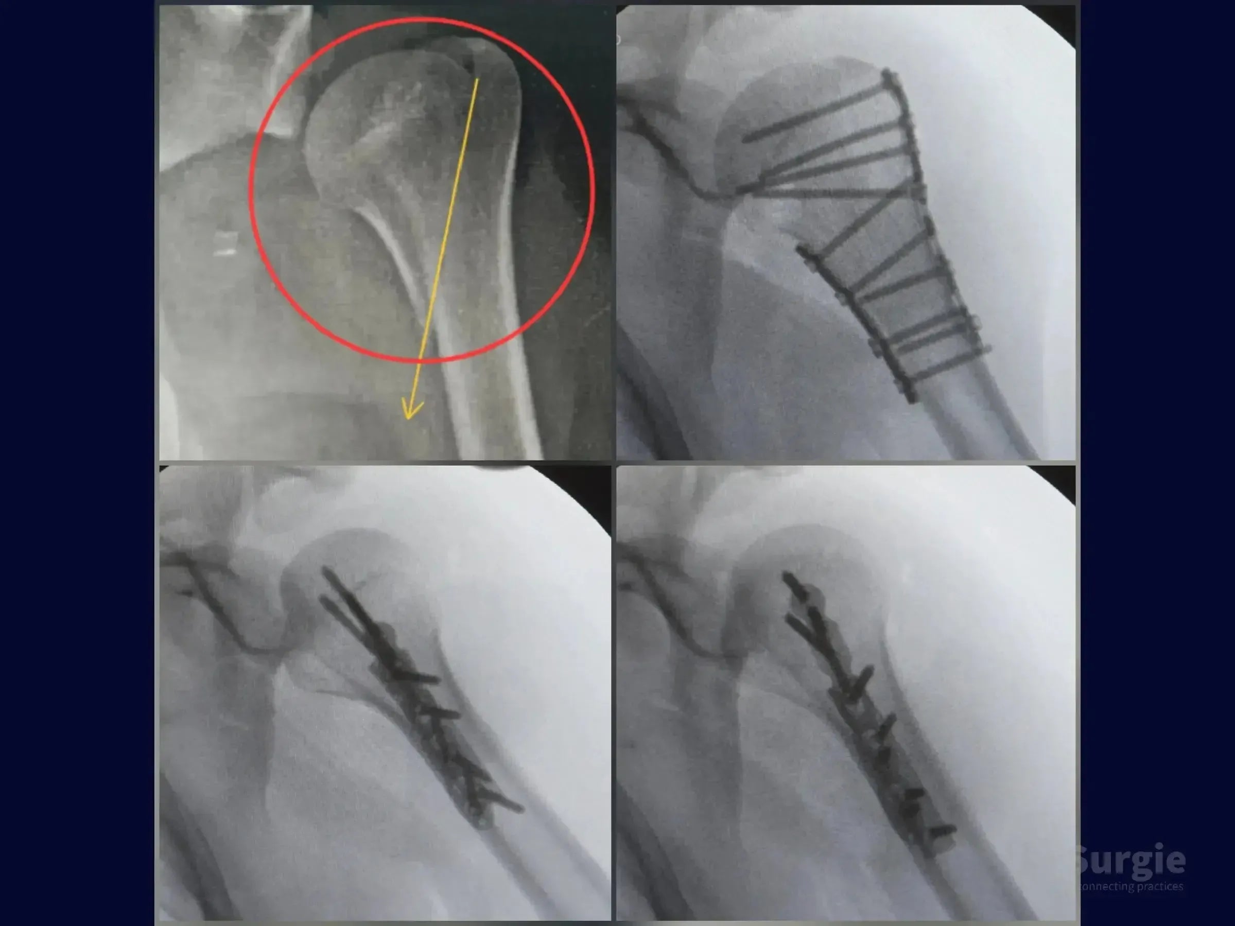 X-ray showing proximal humerus fracture fixation with medial anti-shear and low-profile lateral plates.