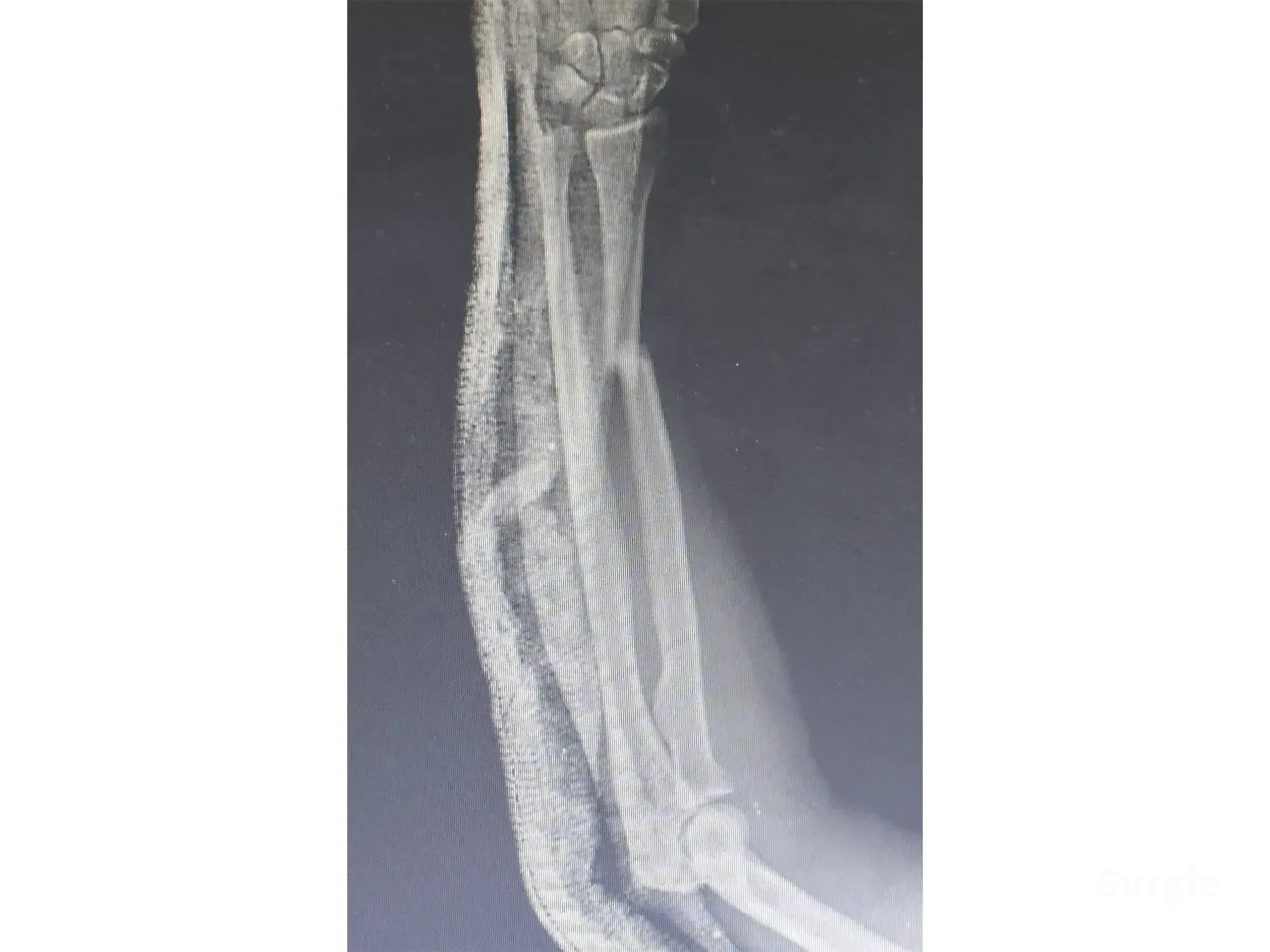 X-ray showing a radial shaft fracture of the forearm with visible bone displacement and soft tissue outline.