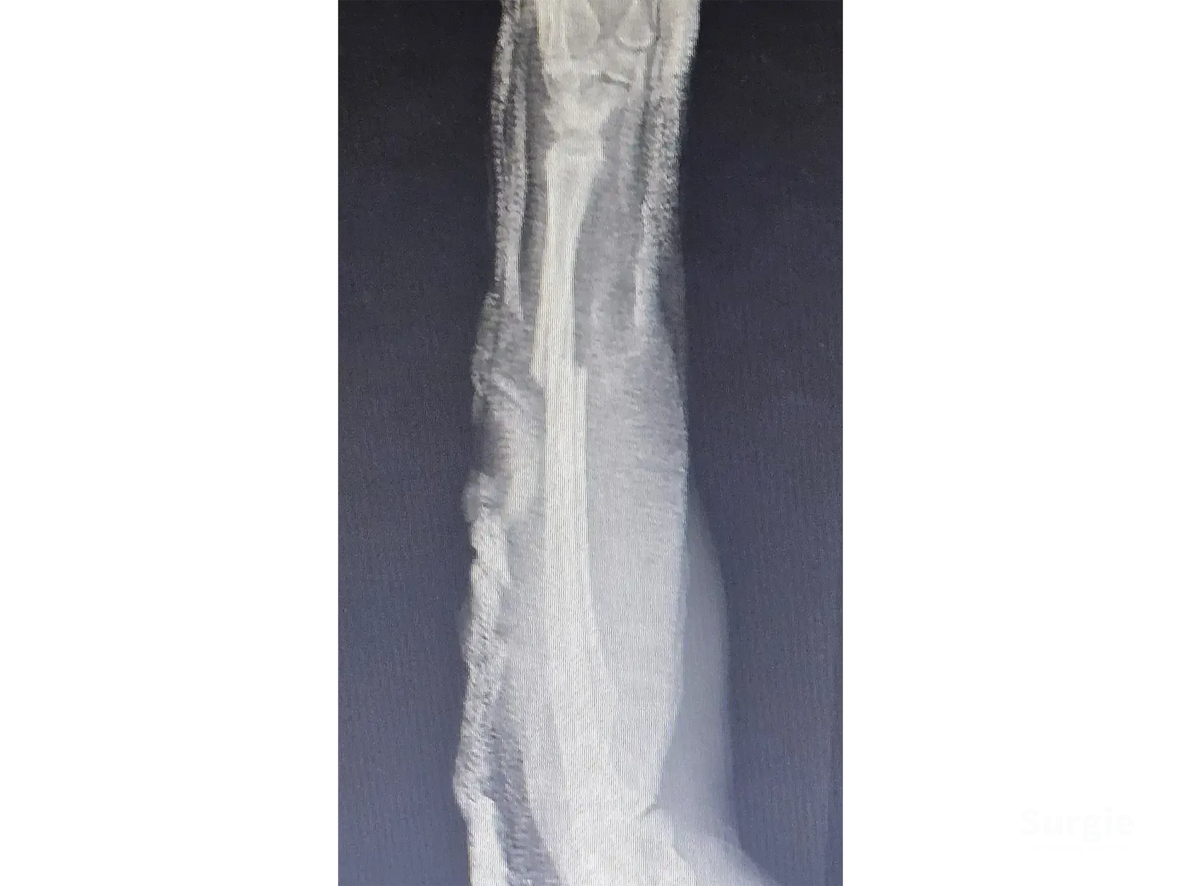 X-ray showing a radial shaft fracture fixed with a 3.5 mm DCP plate and screws for anatomic reduction.