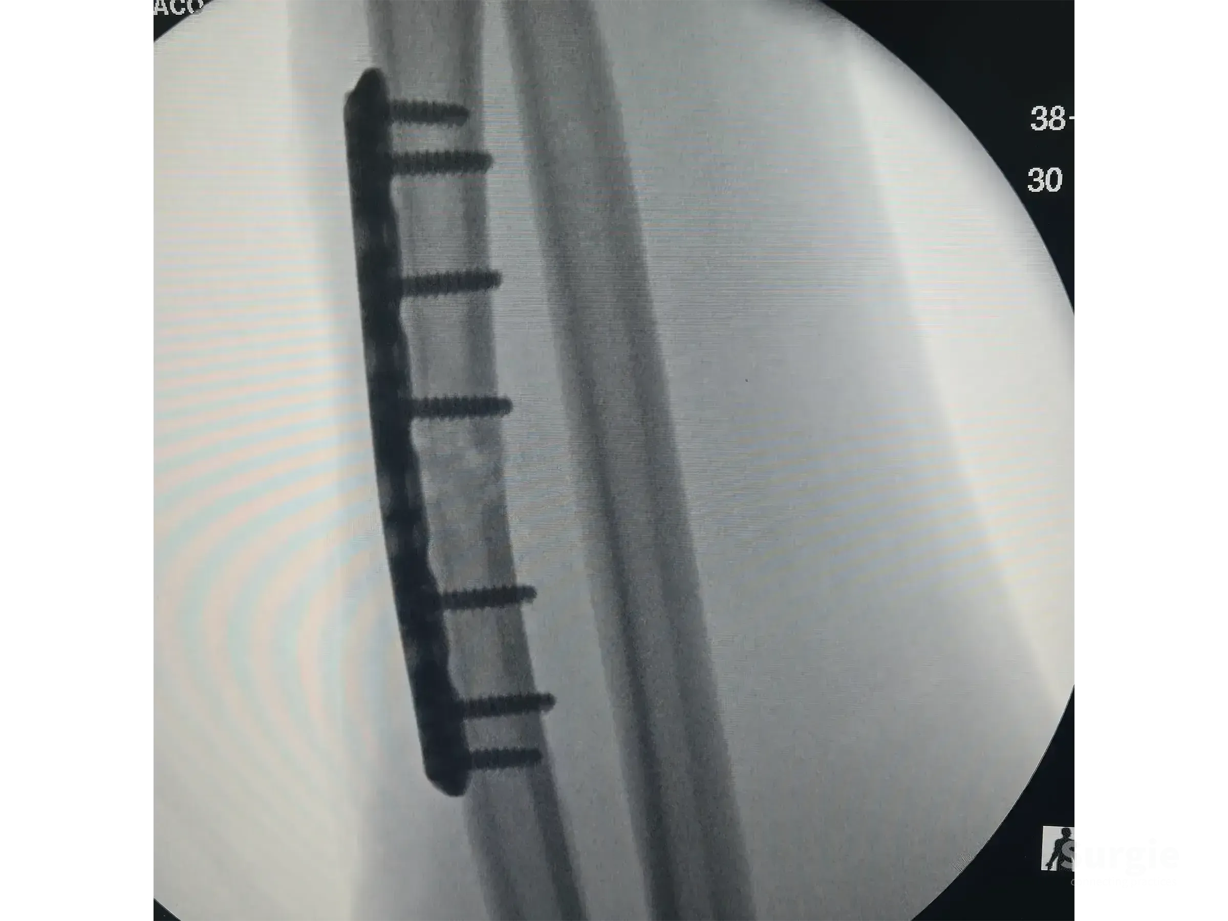 X-ray showing a radial shaft fracture fixed with a 3.5 mm DCP metal plate and six cortical screws.