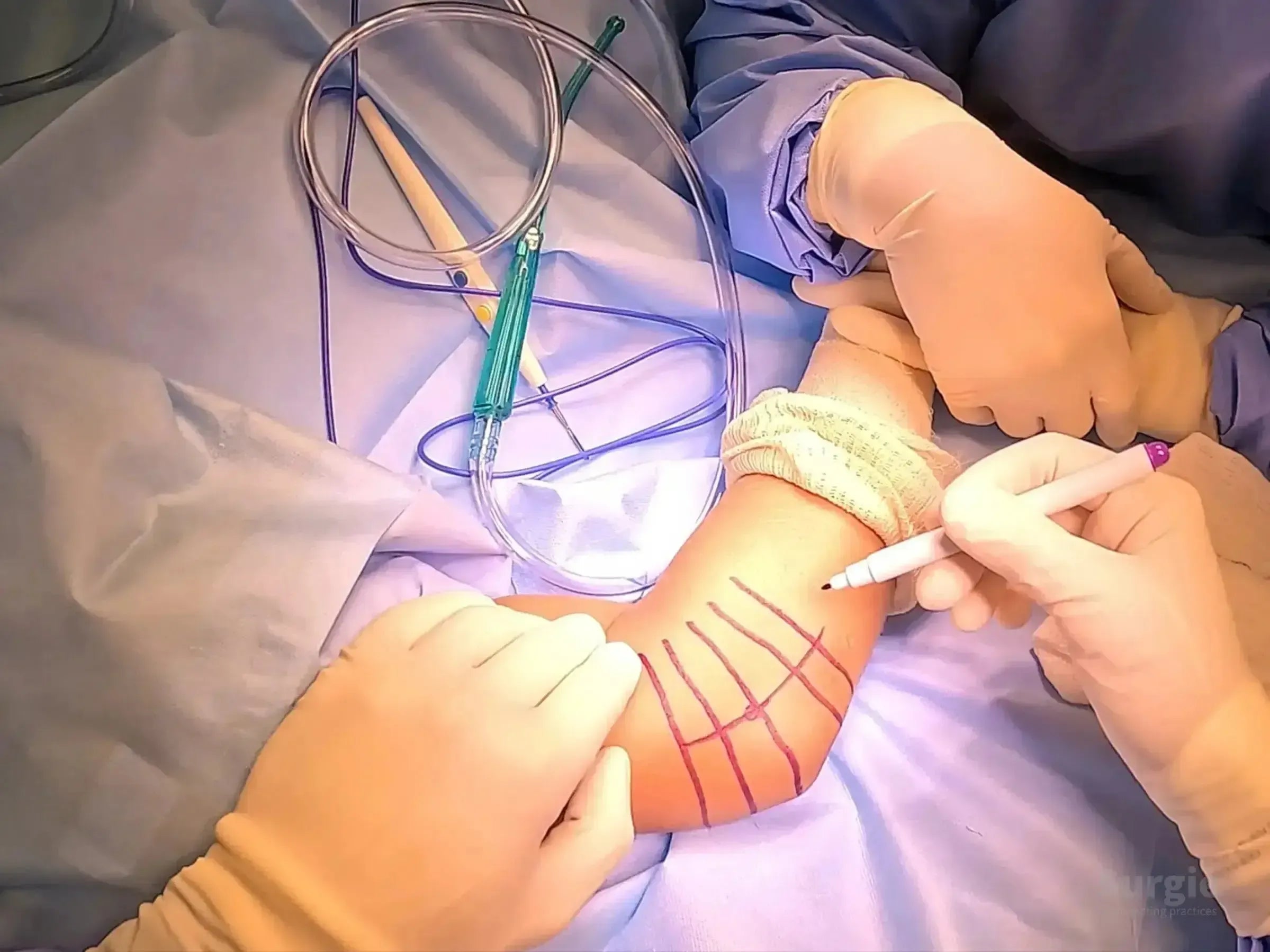 Surgeon marking a patient's elbow with a pen for a radial head arthroplasty procedure on a blue surgical drape.