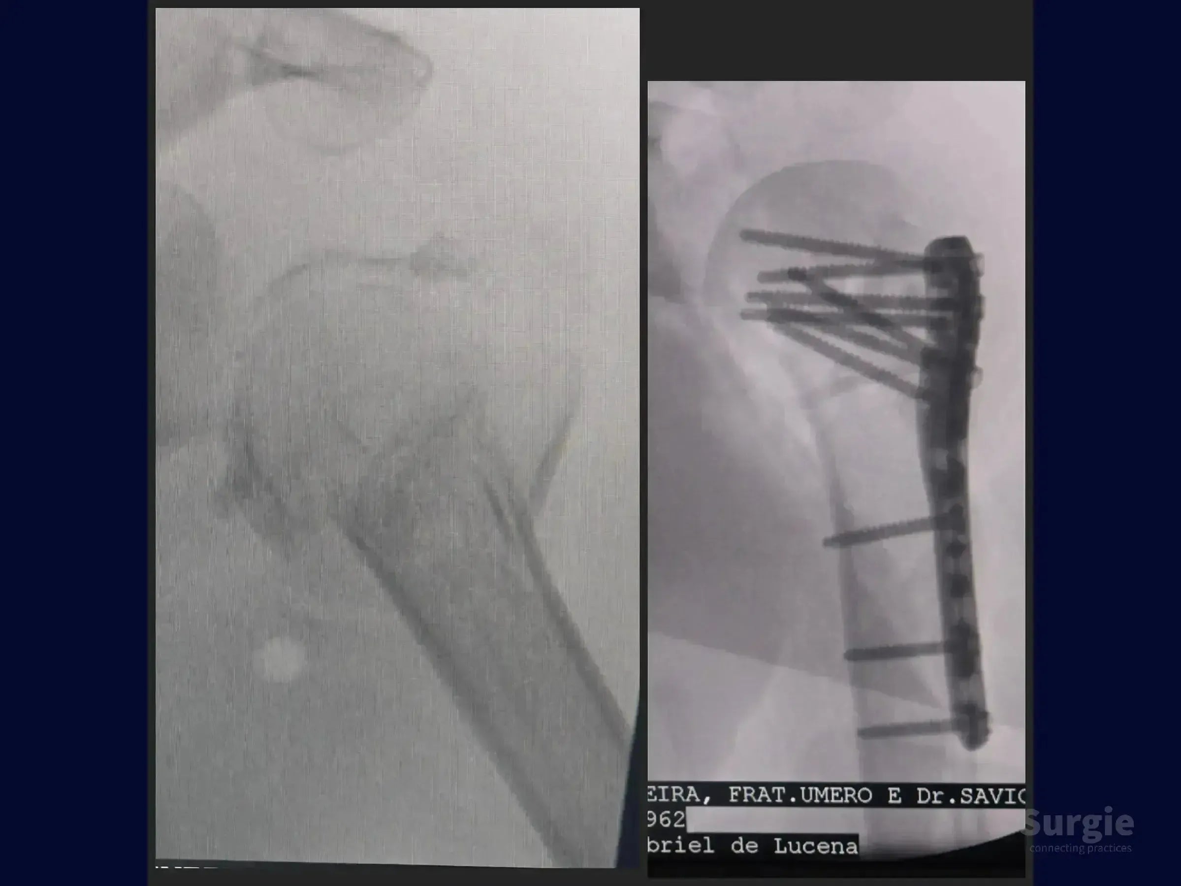 X-ray comparison of a four-part proximal humerus fracture before and after surgical plate and screw fixation.