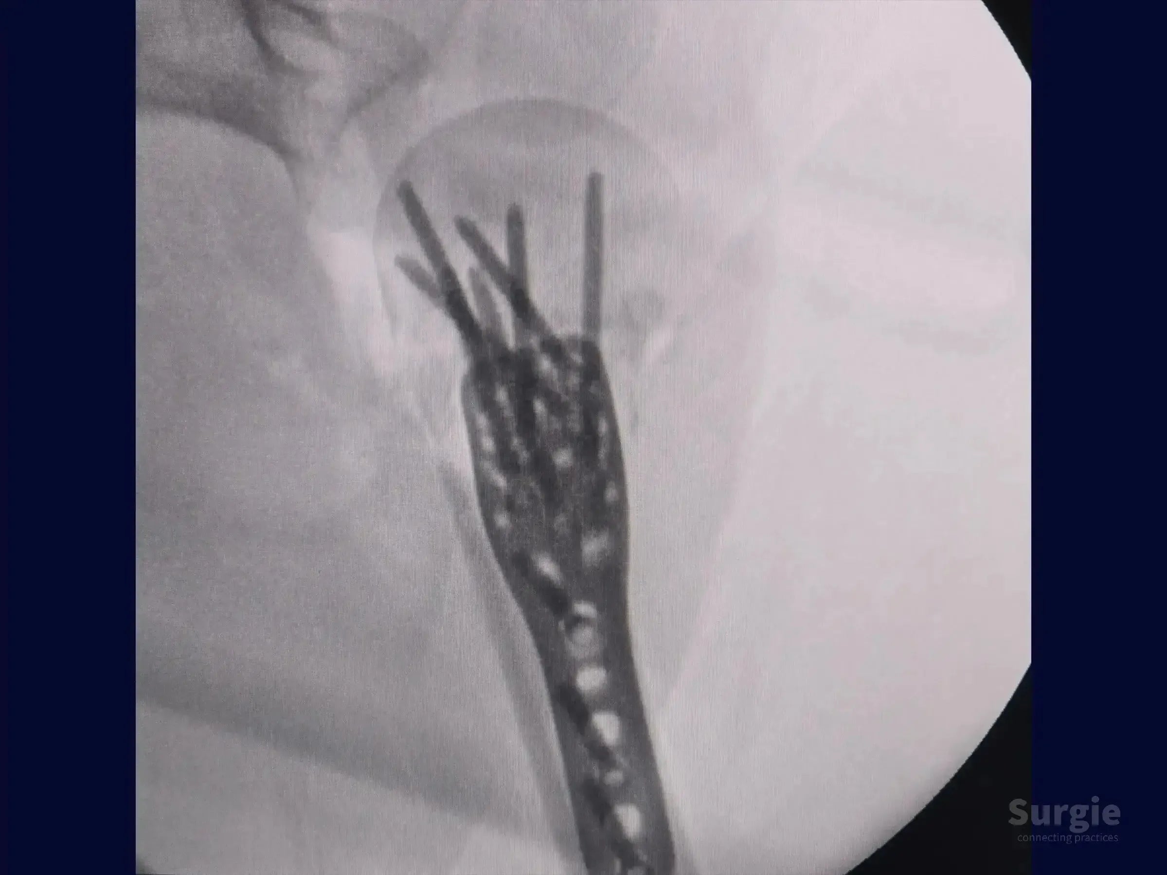 X-ray showing a proximal humerus fracture fixed with a metal plate and multiple locking screws in the humeral head.