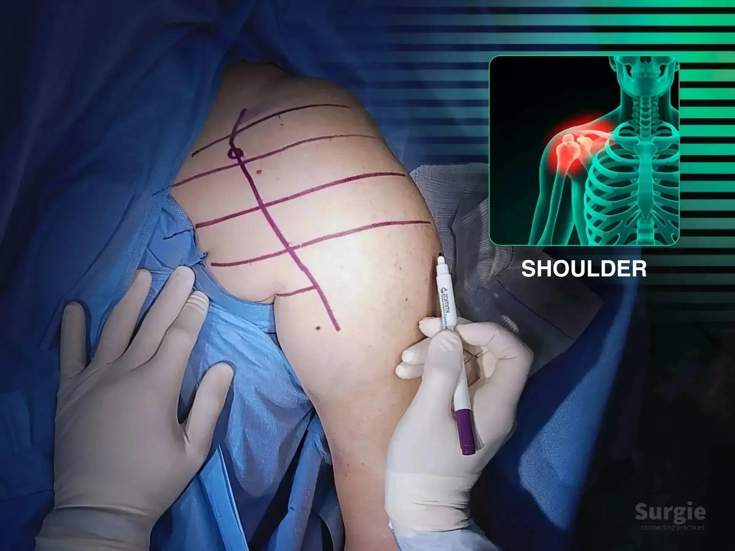 Surgeon marking a patient's shoulder for a deltopectoral approach with an anatomical diagram overlay.