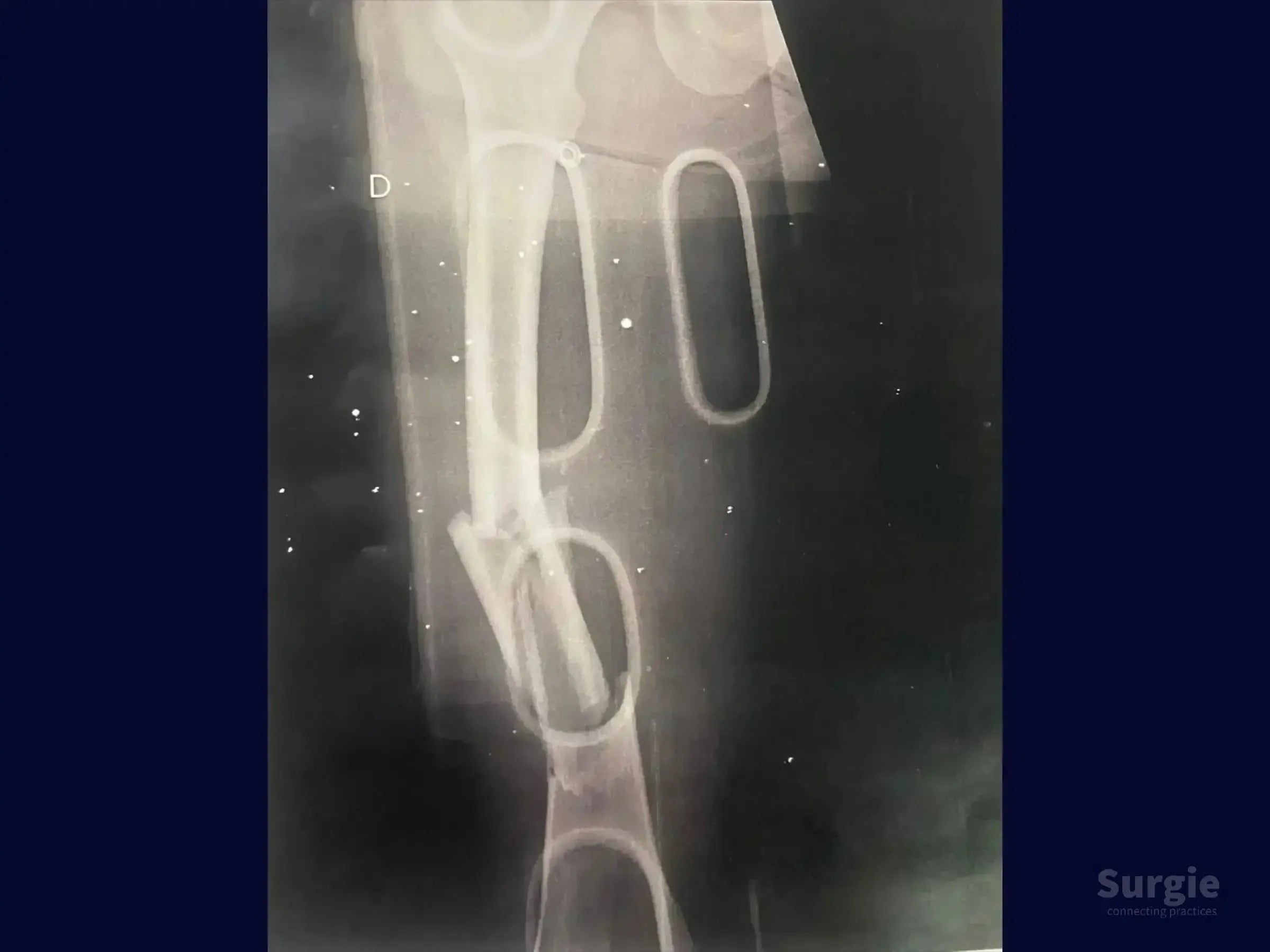 X-ray showing a femoral shaft fracture with highlighted anatomical landmarks for intramedullary nail fixation.