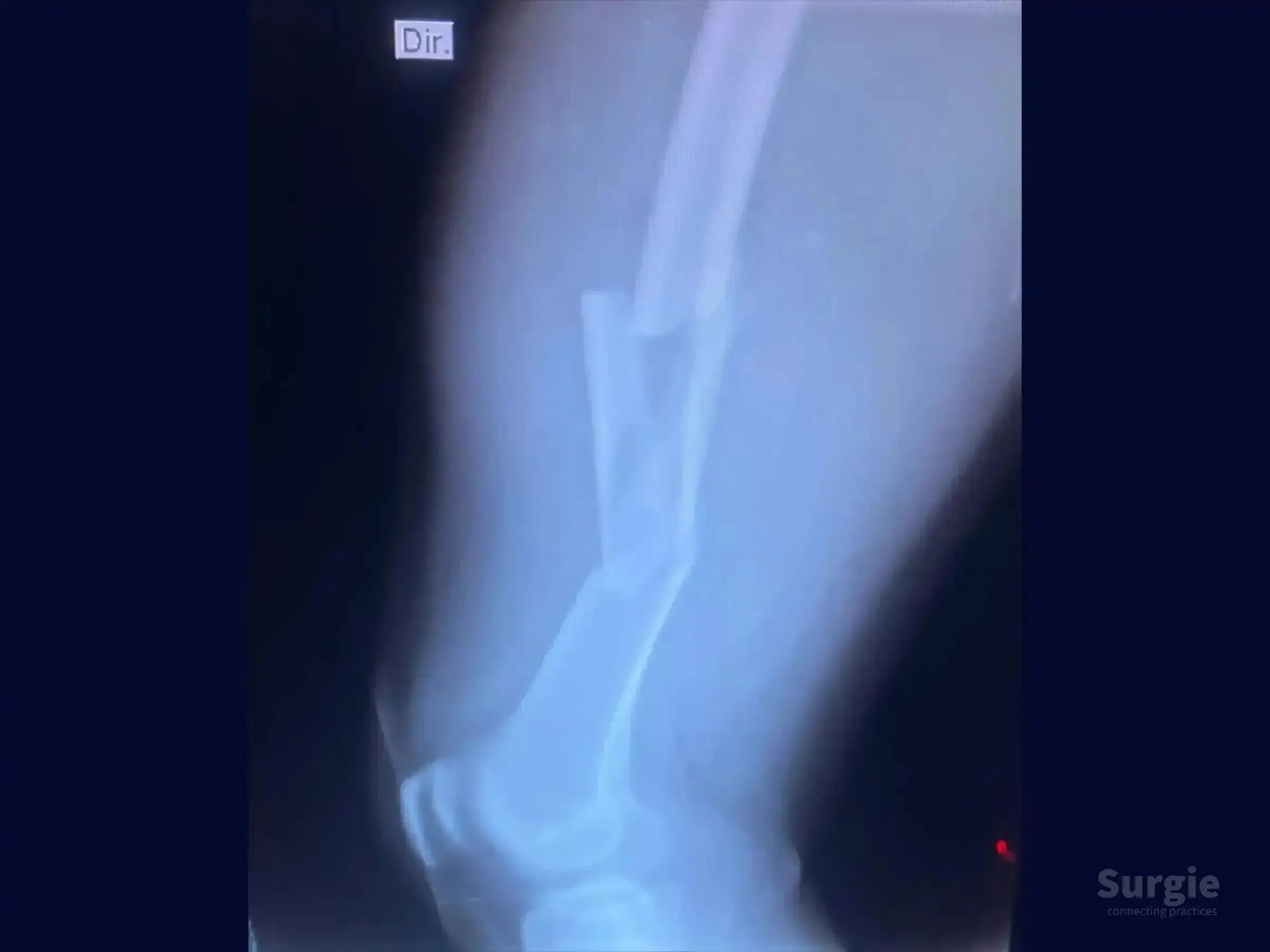 X-ray showing a displaced femoral shaft fracture with bone fragmentation, suitable for intramedullary nail fixation.