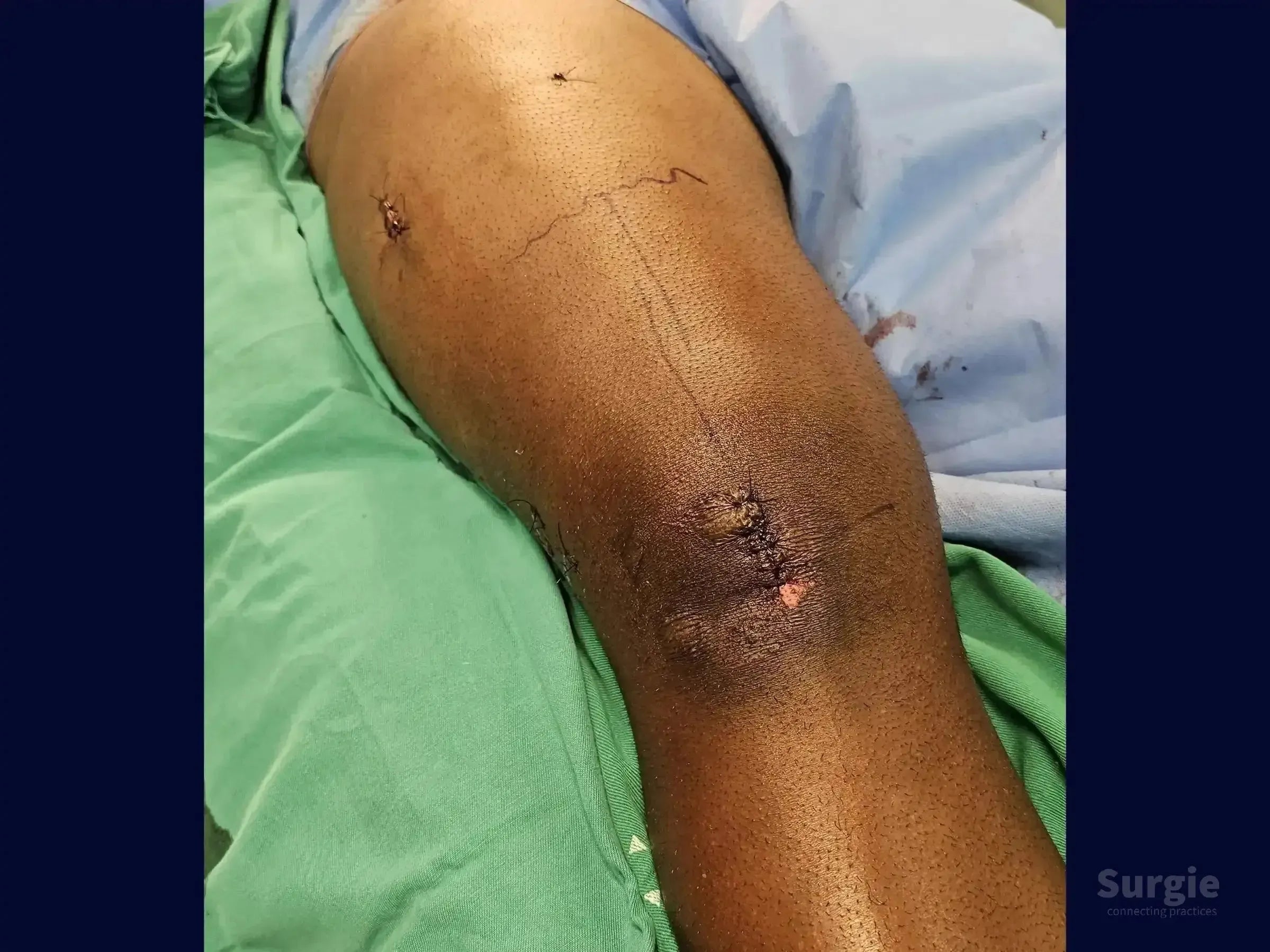 Surgical site on a human knee showing post-operative sutures and markings for intramedullary nailing on a green drape.