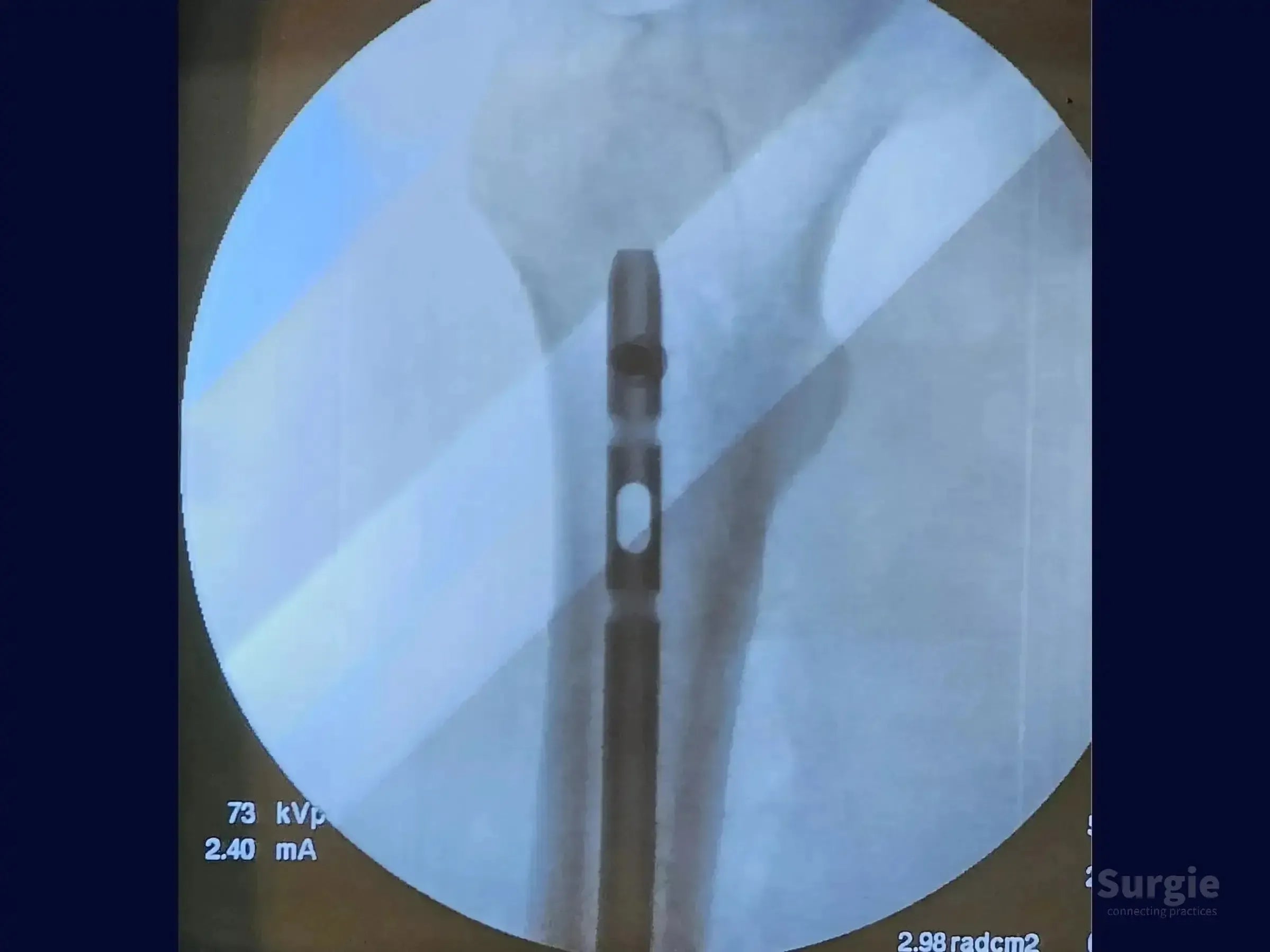 Fluoroscopic view of a metallic intramedullary nail inserted into a femur for fracture fixation surgery.