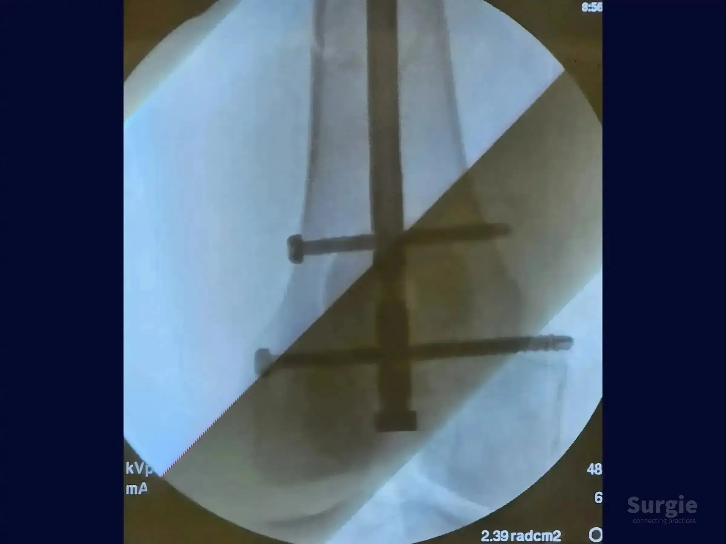 X-ray showing a metallic intramedullary nail with two distal locking screws in a femoral shaft fracture.