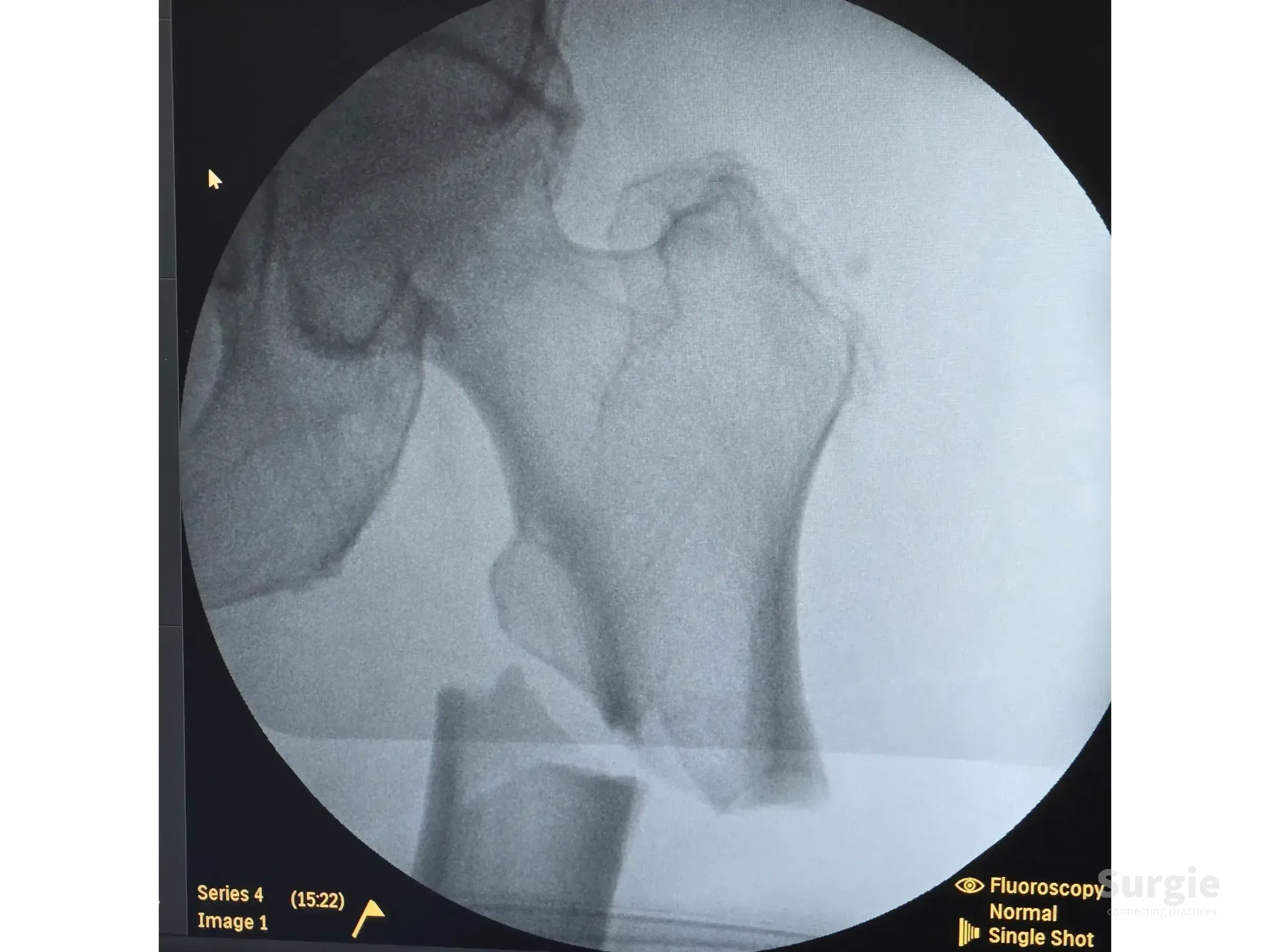 Fluoroscopic X-ray showing a subtrochanteric femur fracture with proximal fragment displacement and deformity.