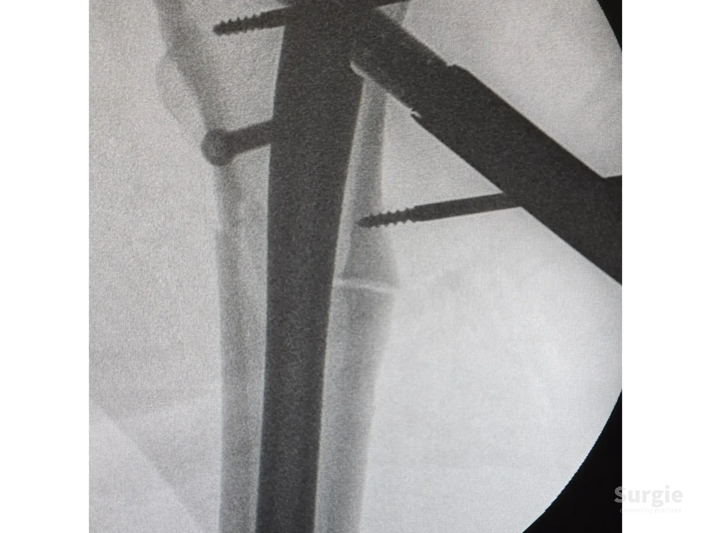 X-ray showing a metallic intramedullary nail fixating a subtrochanteric femur fracture with proximal locking screws.