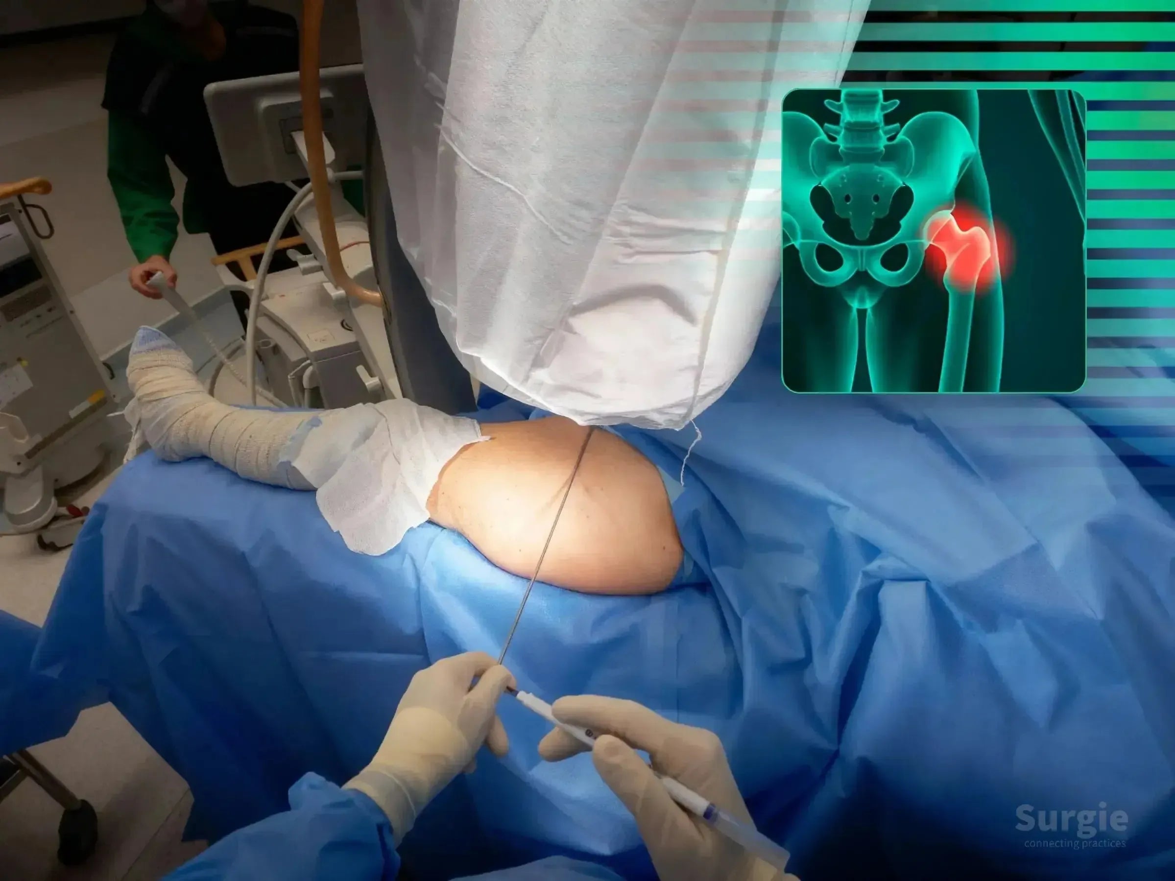 Surgical procedure for subtrochanteric fracture using a guidewire, with an anatomical overlay of the hip joint.