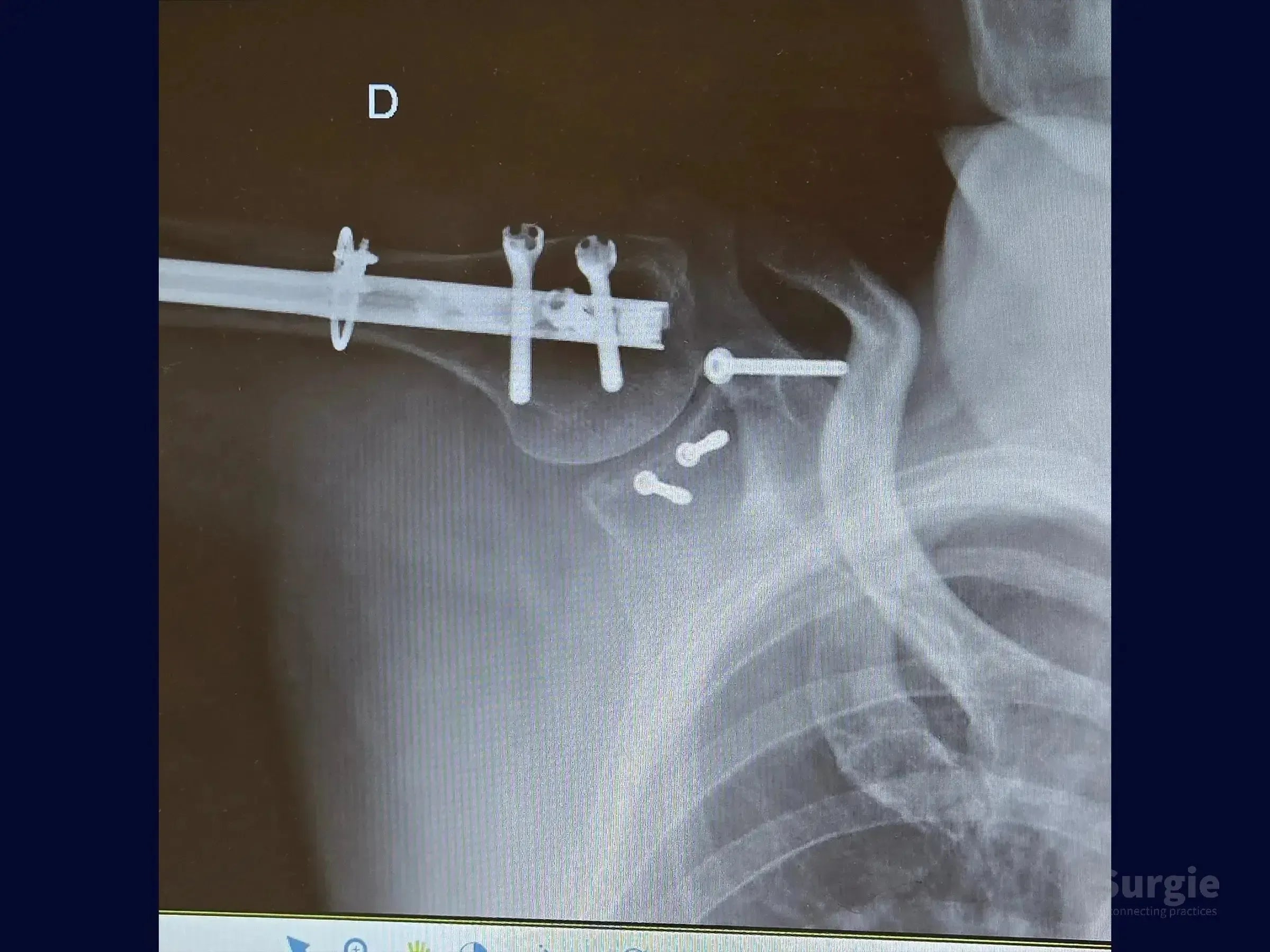 X-ray showing humeral intramedullary nail, cerclage, and screws fixing glenoid and coracoid process fractures.
