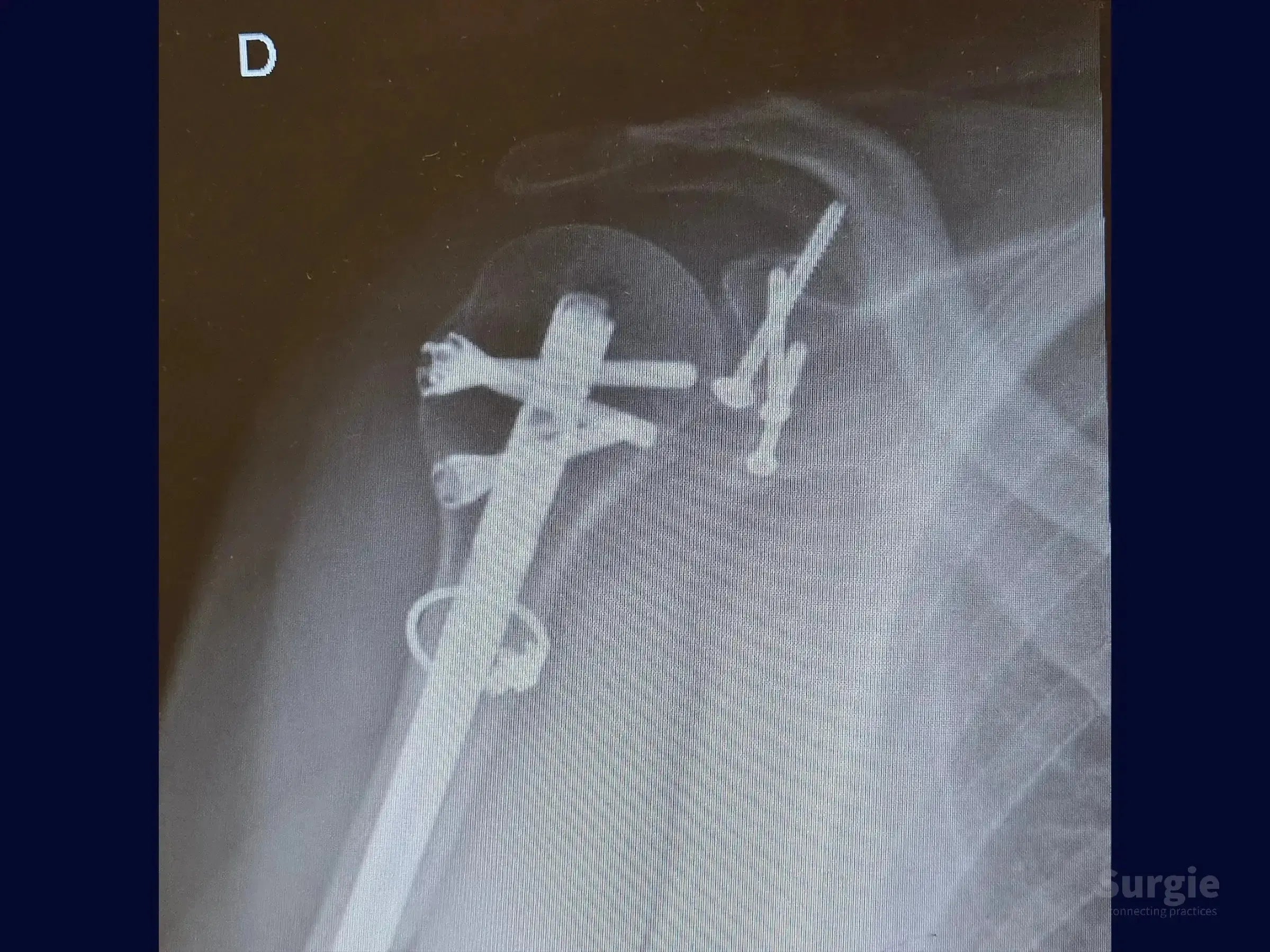 X-ray showing a humeral intramedullary nail, cerclage wire, and screws fixing glenoid and coracoid process fractures.