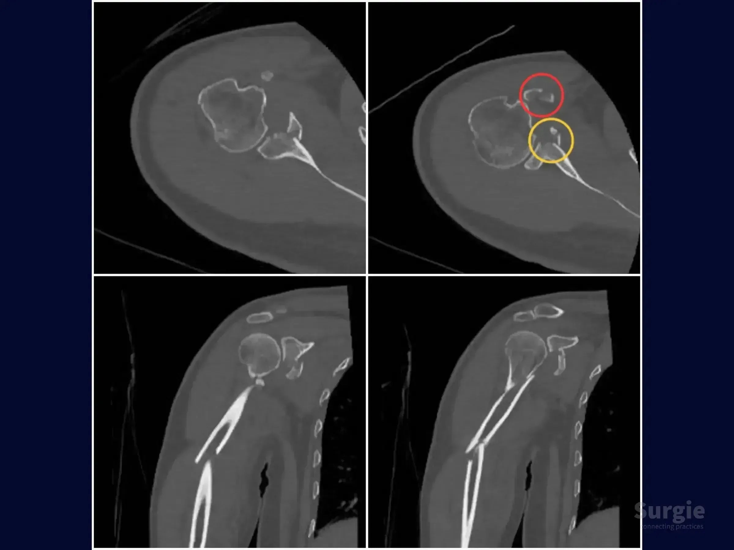 CT scan showing segmental humeral fracture with highlighted glenoid and coracoid process fractures in grayscale.