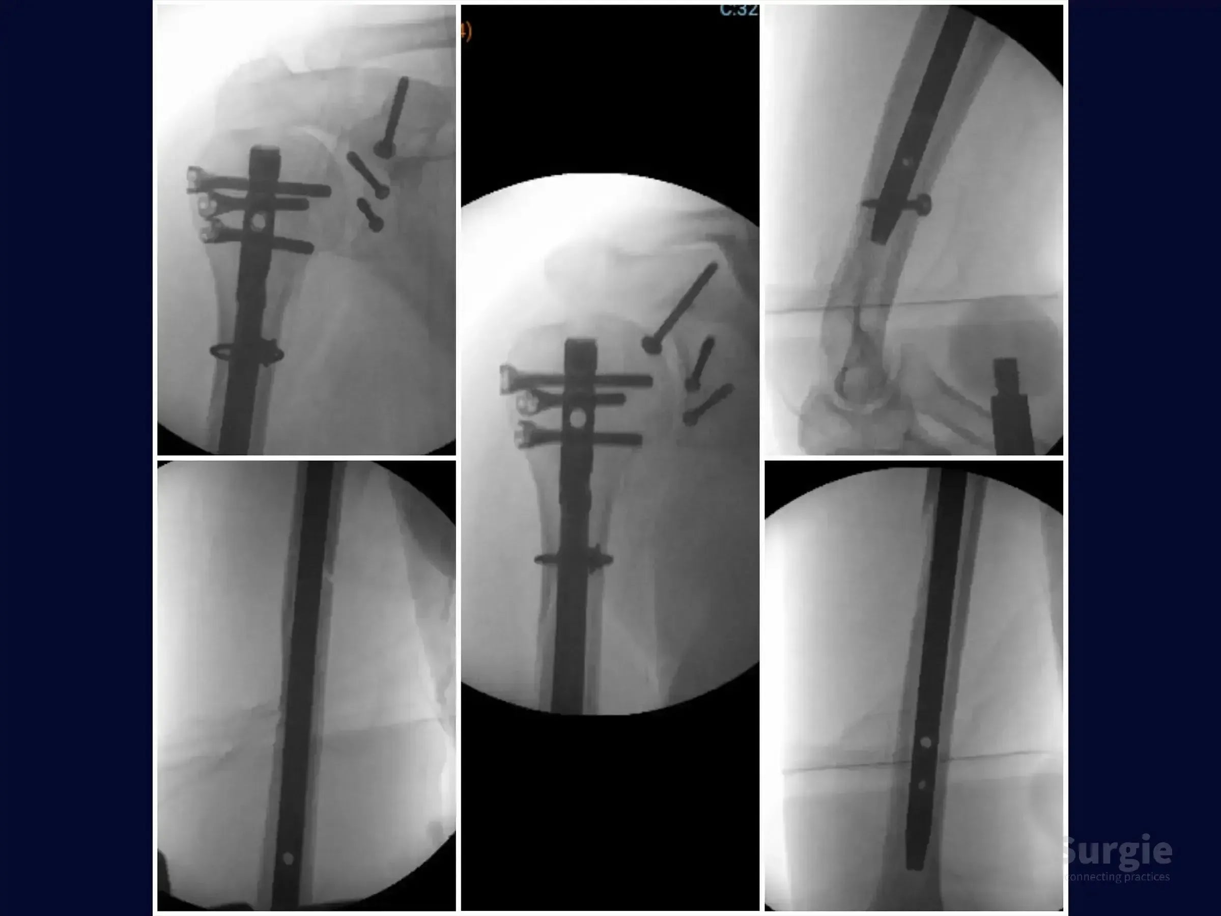 X-ray showing humeral intramedullary nail fixation with screws in the glenoid and coracoid process for complex shoulder fractures.