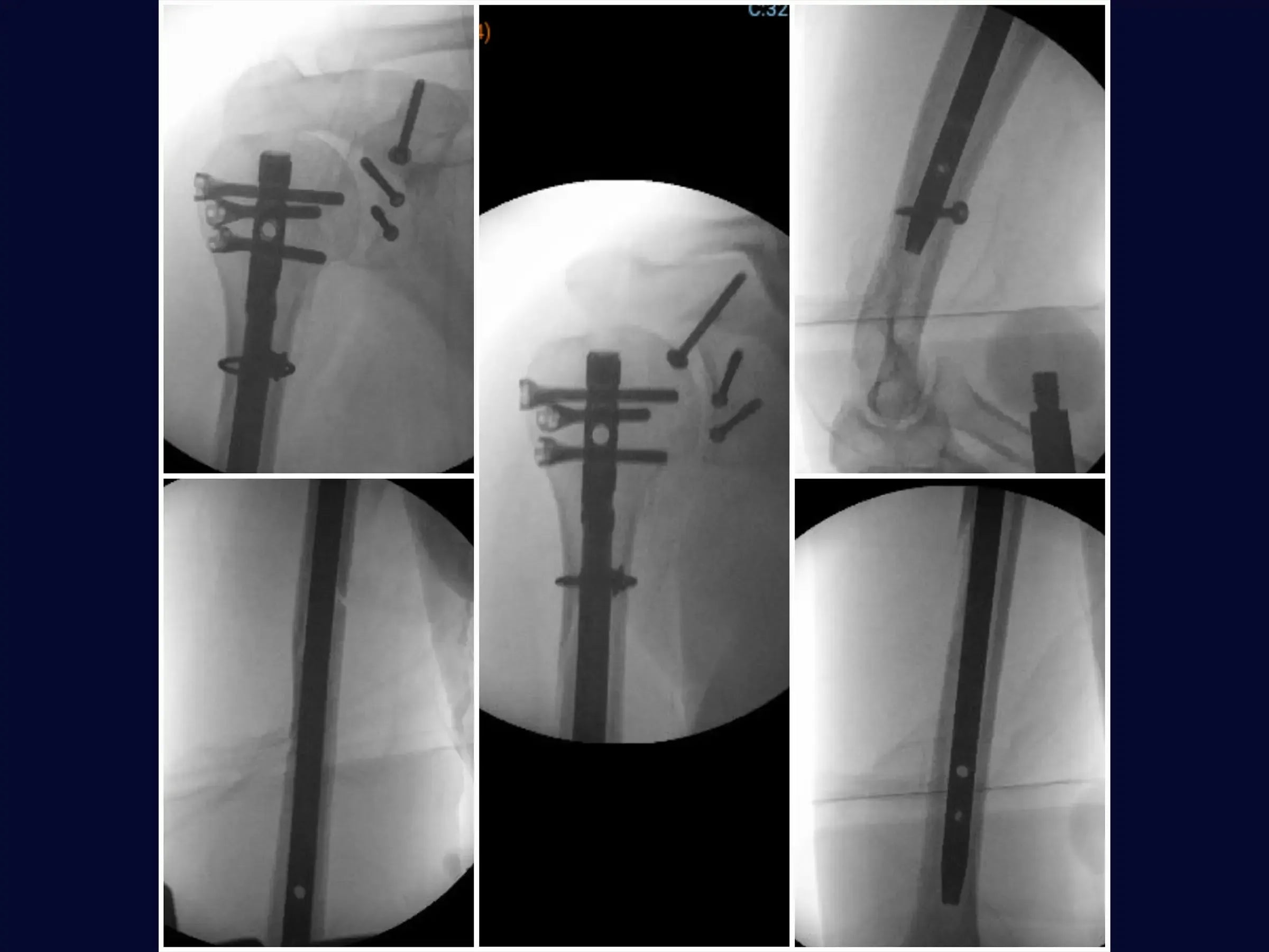 Segmentale Humerusfraktur assoziiert mit Glenoid- und Korakoidfrakturen