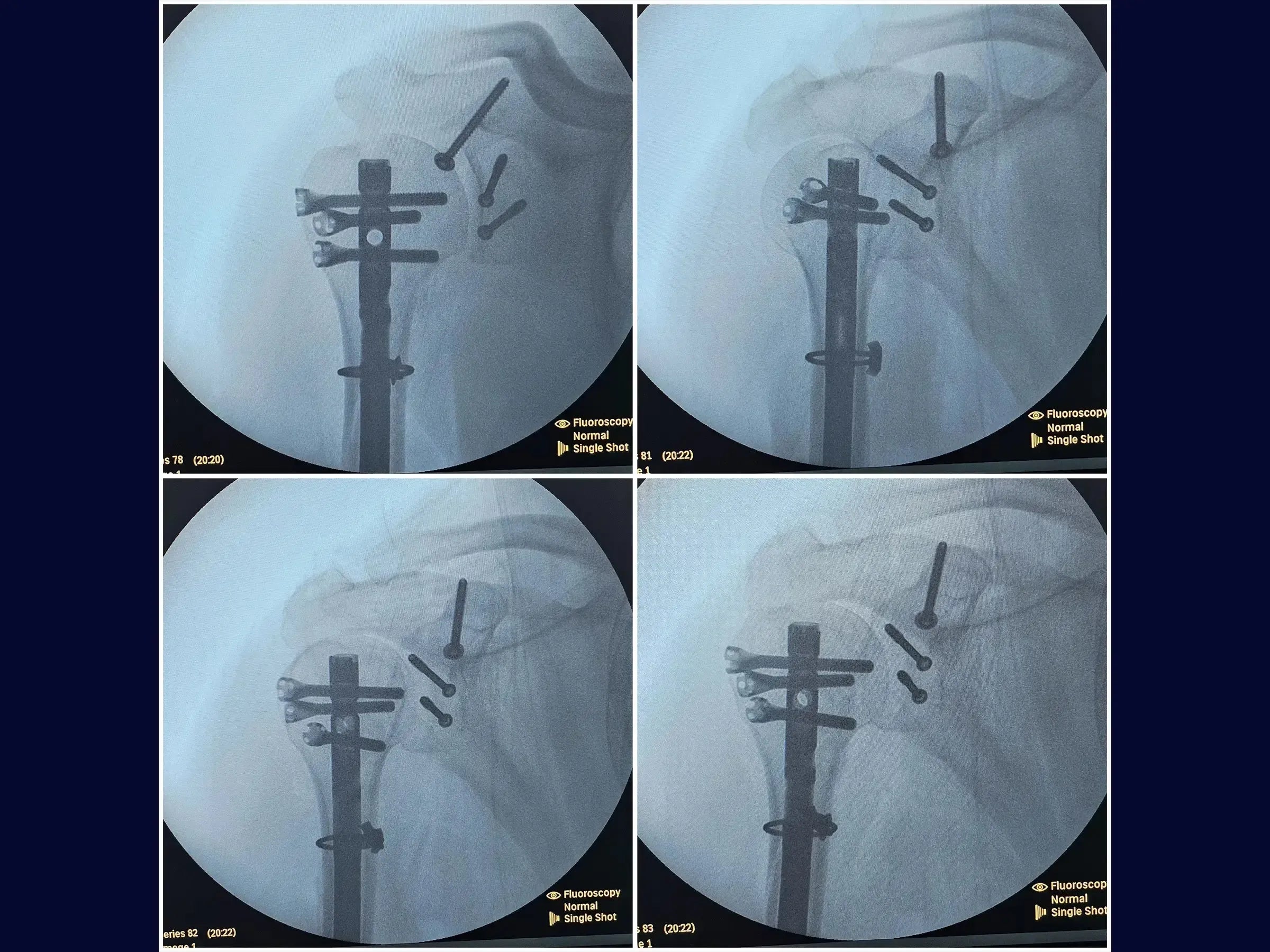 Segmentale Humerusfraktur assoziiert mit Glenoid- und Korakoidfrakturen