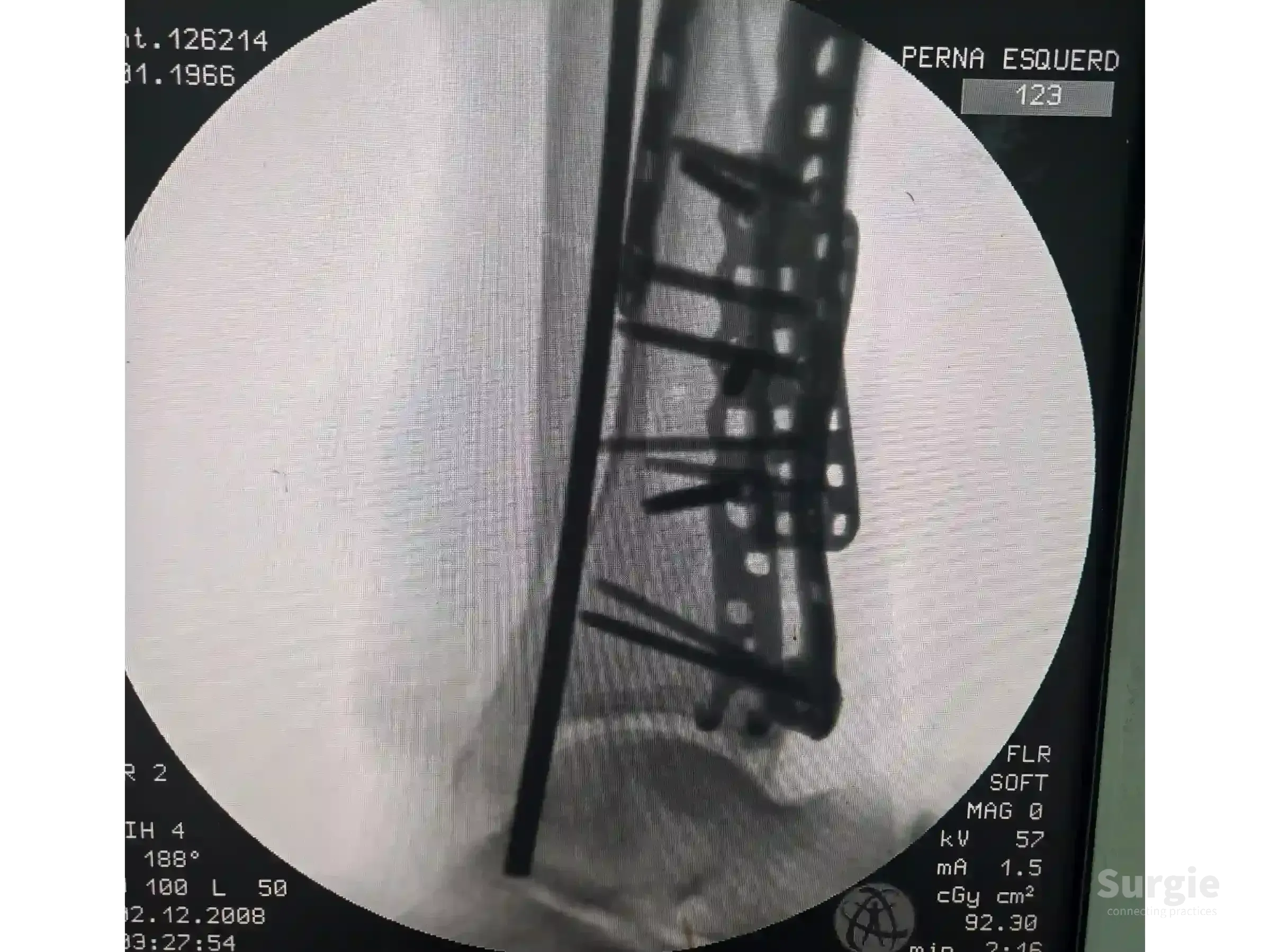Fluoroscopic X-ray showing a tibial pilon fracture stabilized with a metal plate and multiple orthopedic screws.