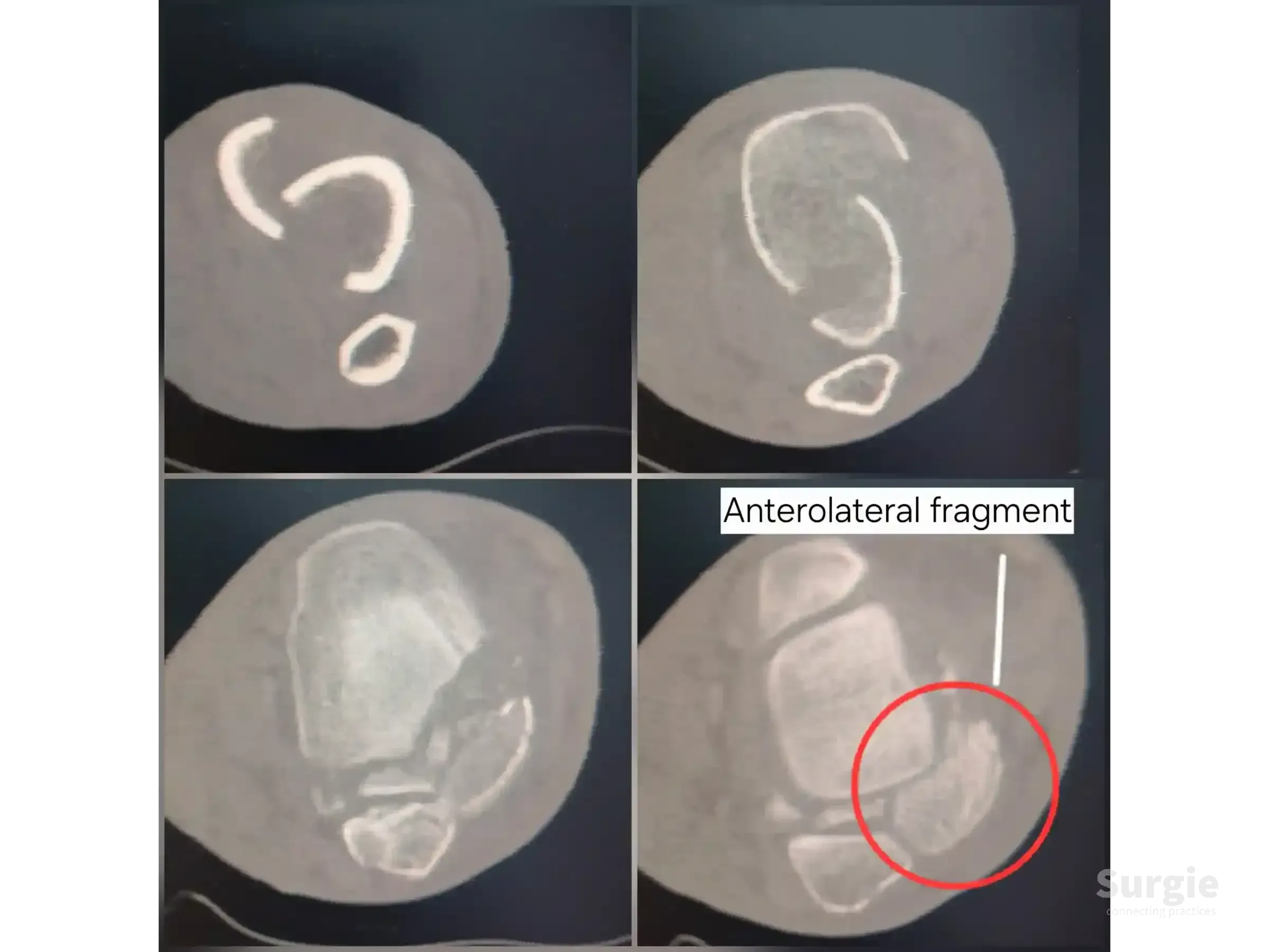 Axial CT scan showing a tibial pilon fracture with a highlighted displaced anterolateral fragment.