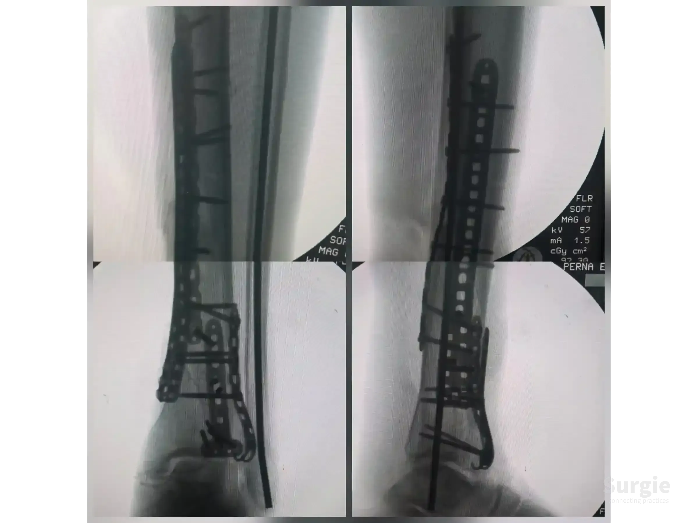 X-ray showing tibial pilon fracture fixation with metal plates and screws using anterolateral and posteromedial approaches.
