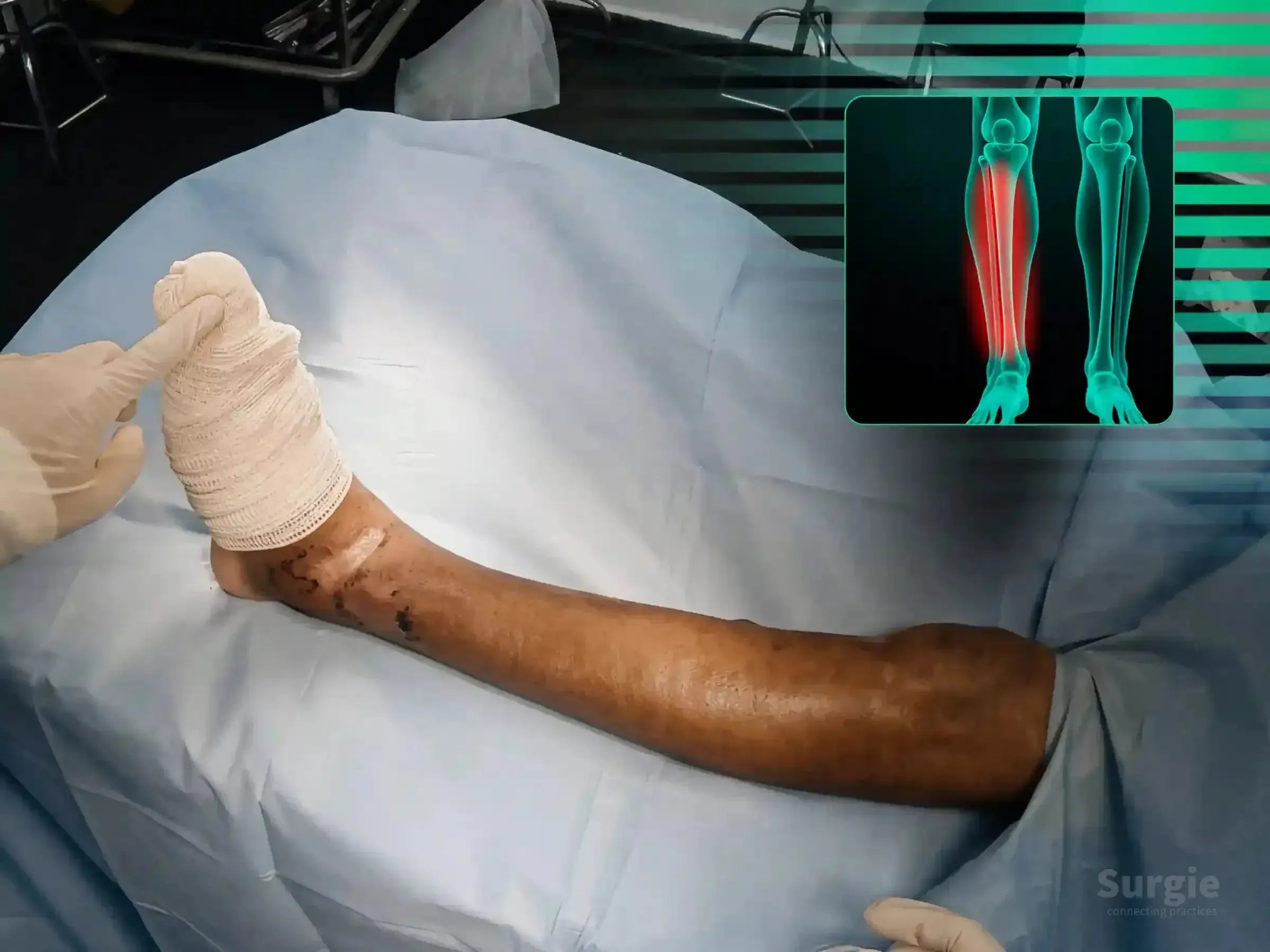 Bandaged lower leg with a tibial pilon fracture and an anatomical X-ray overlay showing the affected bone area.