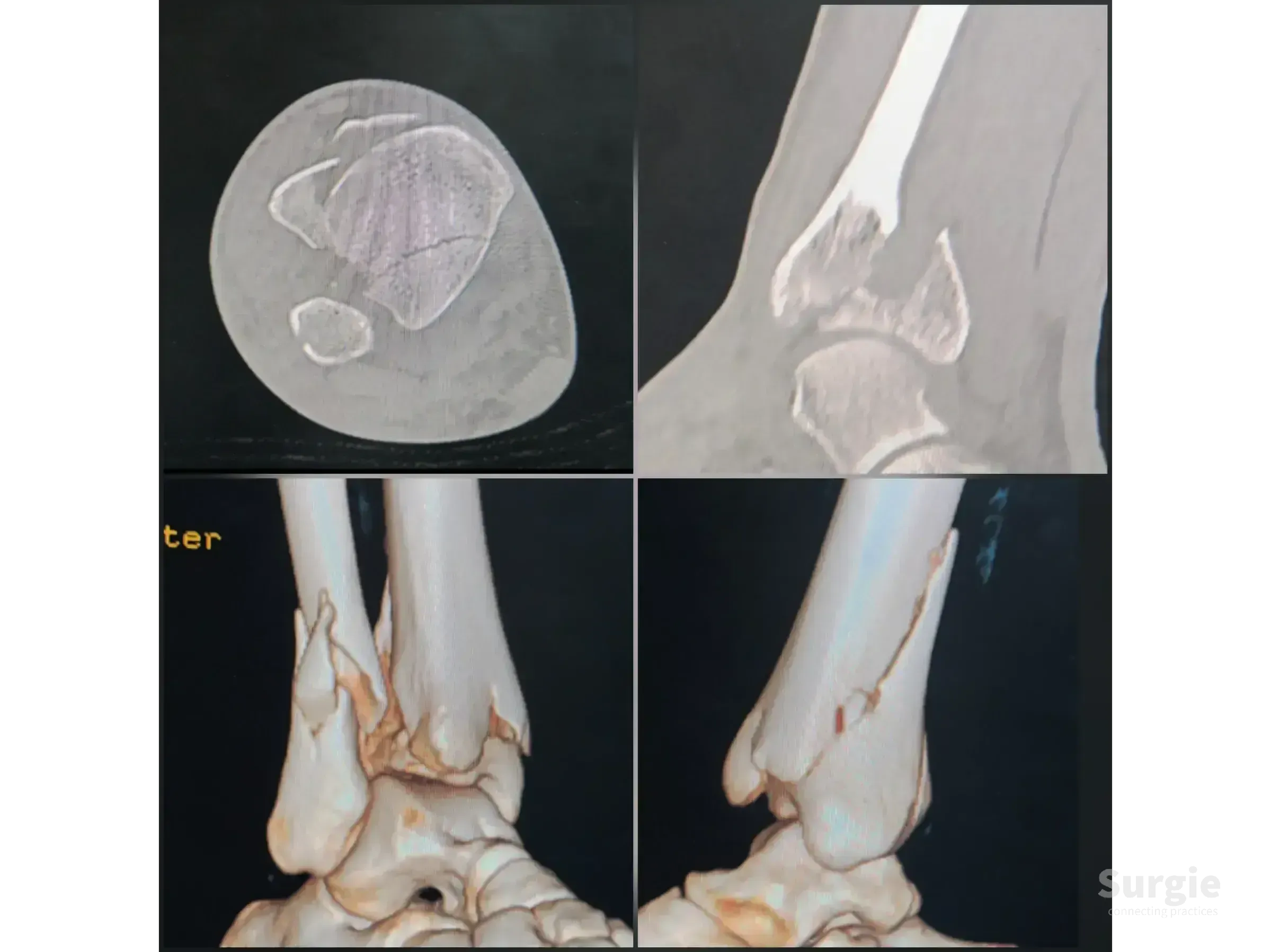 CT scan and 3D reconstruction of a complex tibial pilon fracture showing bone fragments and joint displacement.