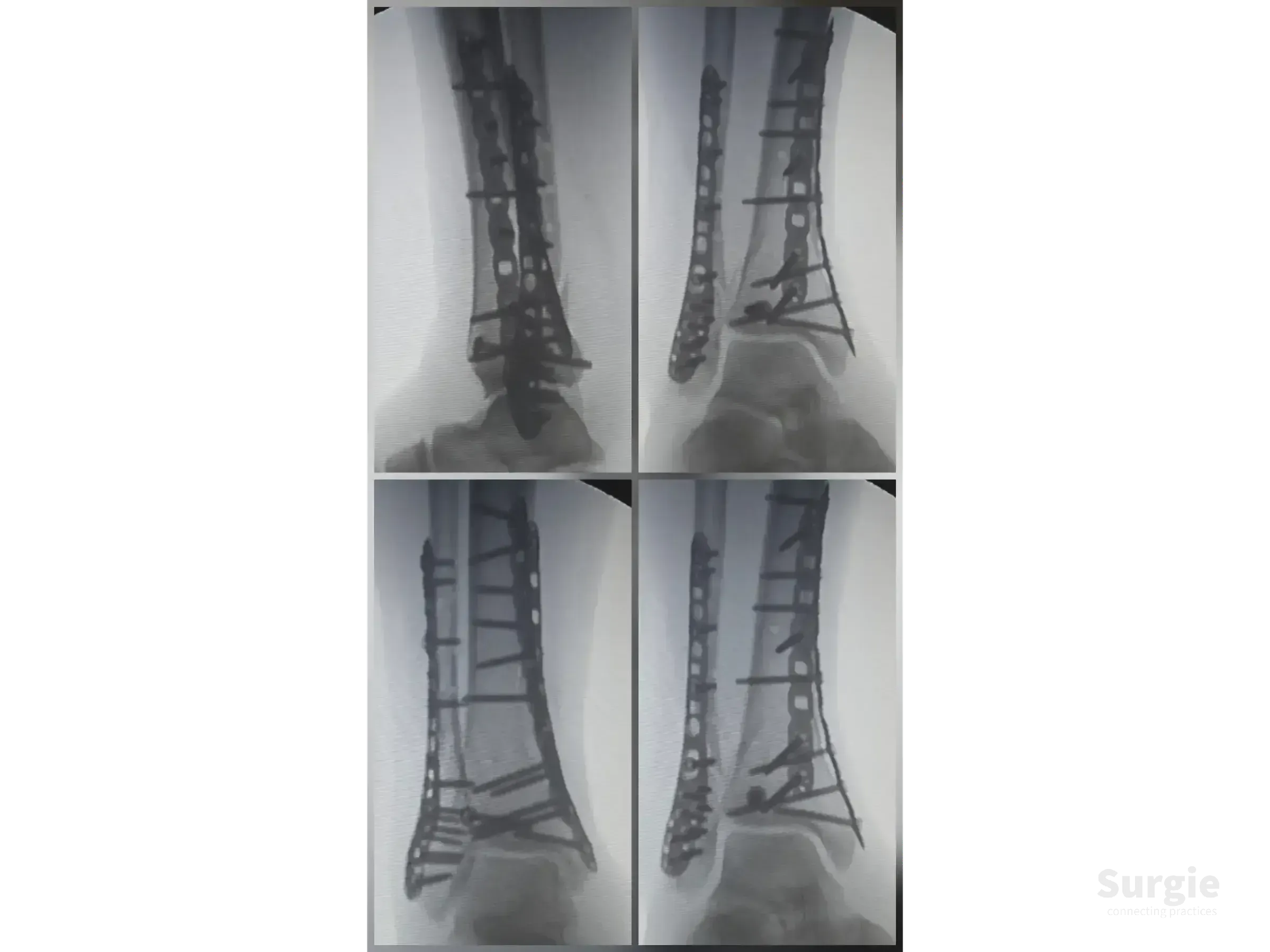 X-ray showing titanium plates and screws fixating a complex tibial pilon fracture with posteromedial and lateral access.
