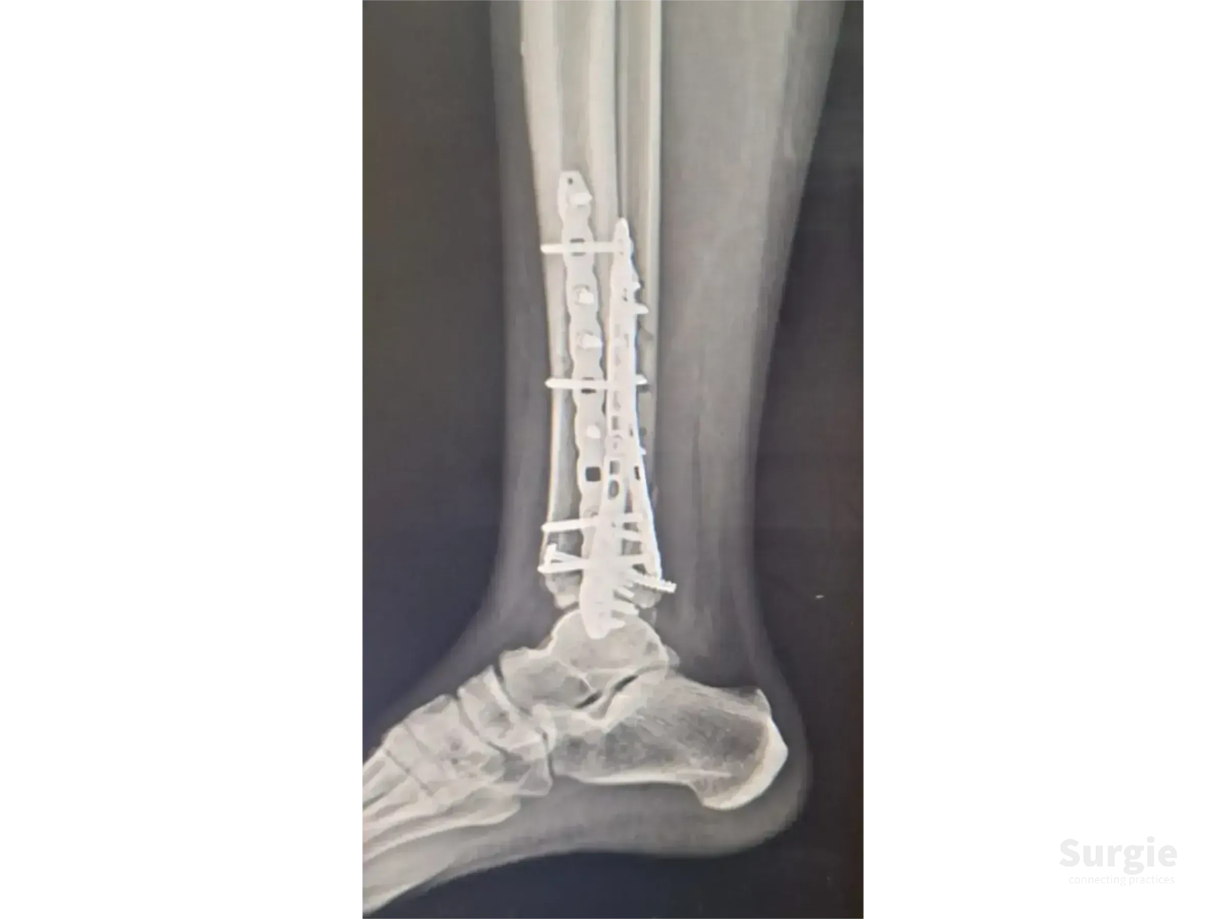 Lateral X-ray of a tibial pilon fracture fixed with titanium plates and screws along the distal tibia and fibula.