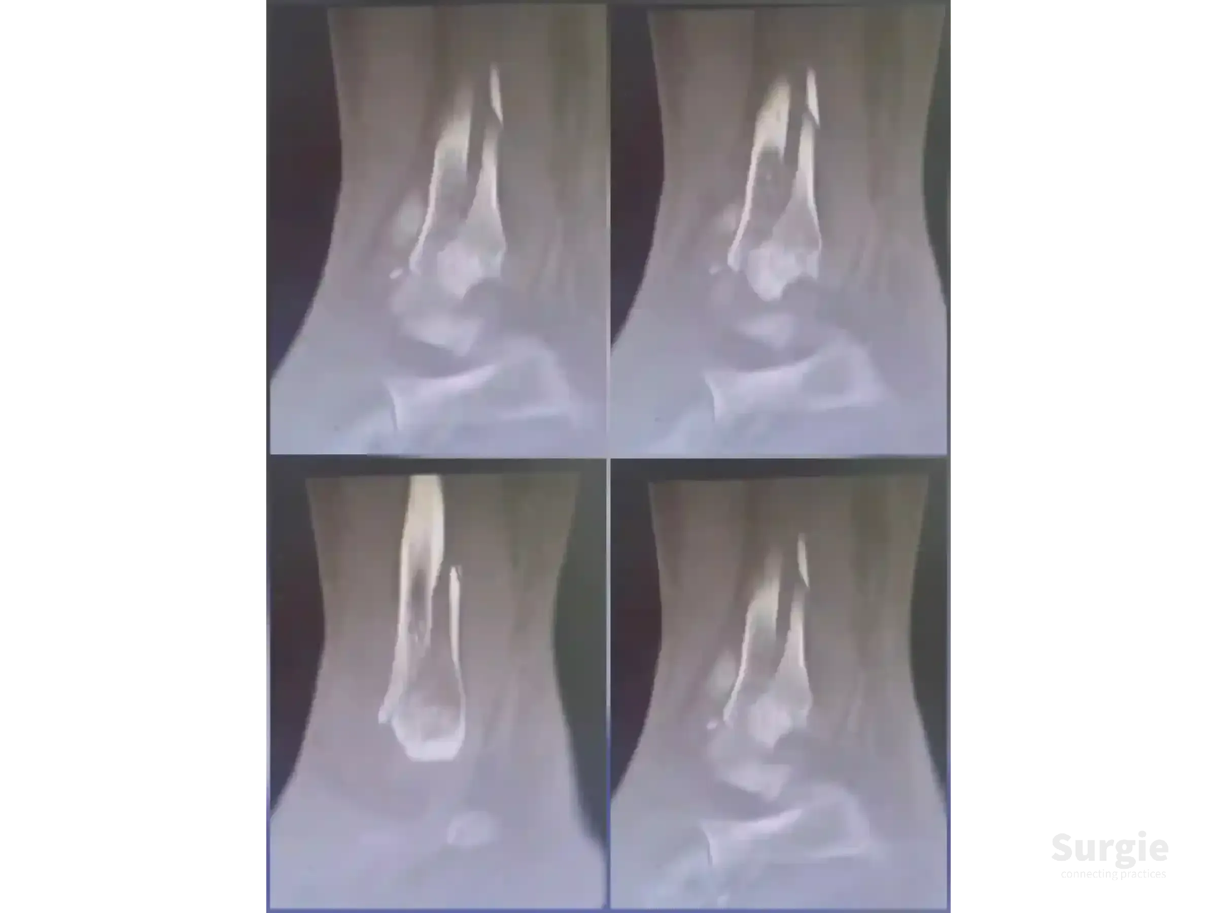Four grayscale X-ray views showing a trimalleolar ankle fracture with an inverted oblique medial malleolus fracture.