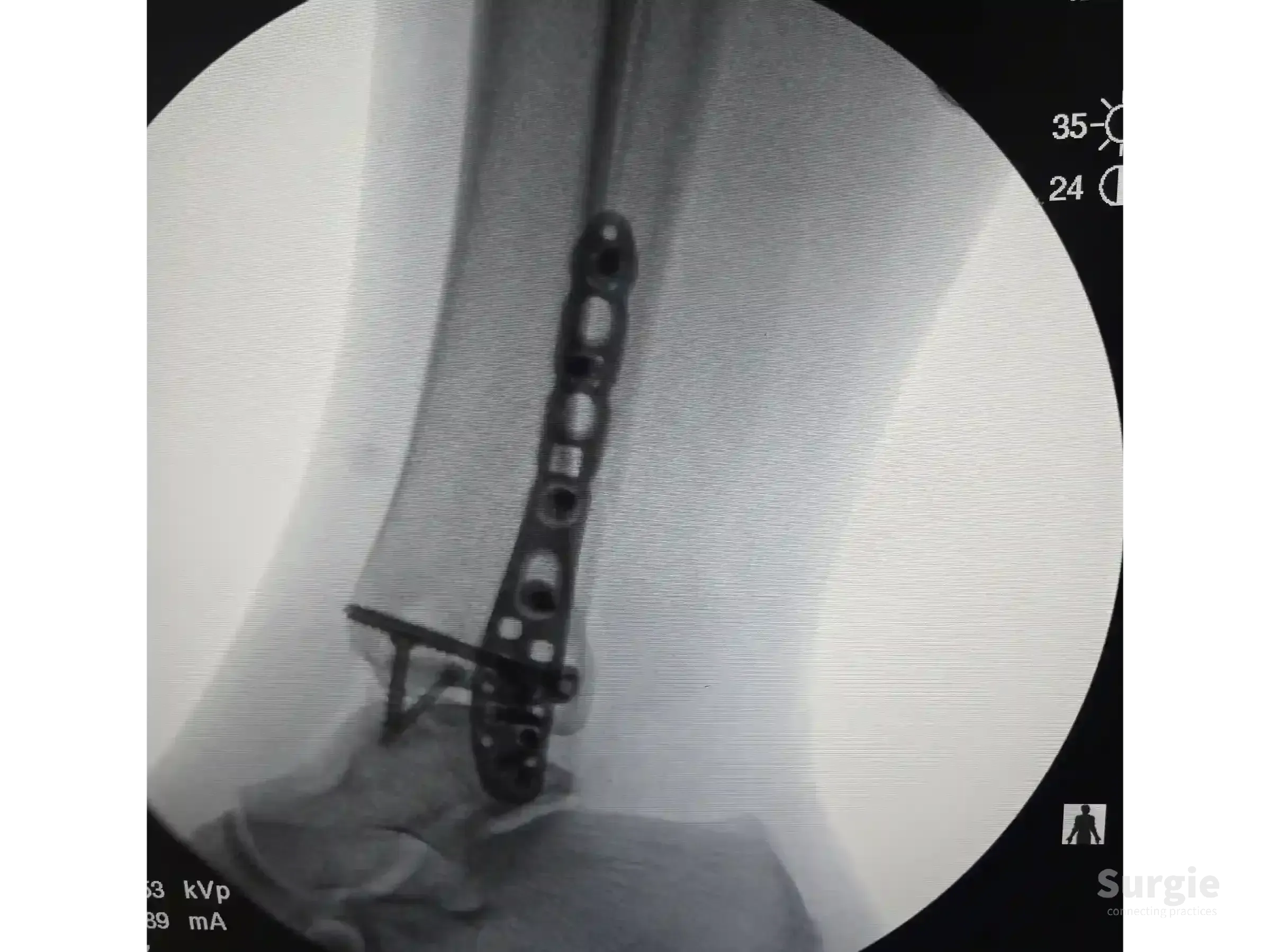 X-ray showing a metal plate and screws fixing a trimalleolar ankle fracture with posterior malleolus stabilization.